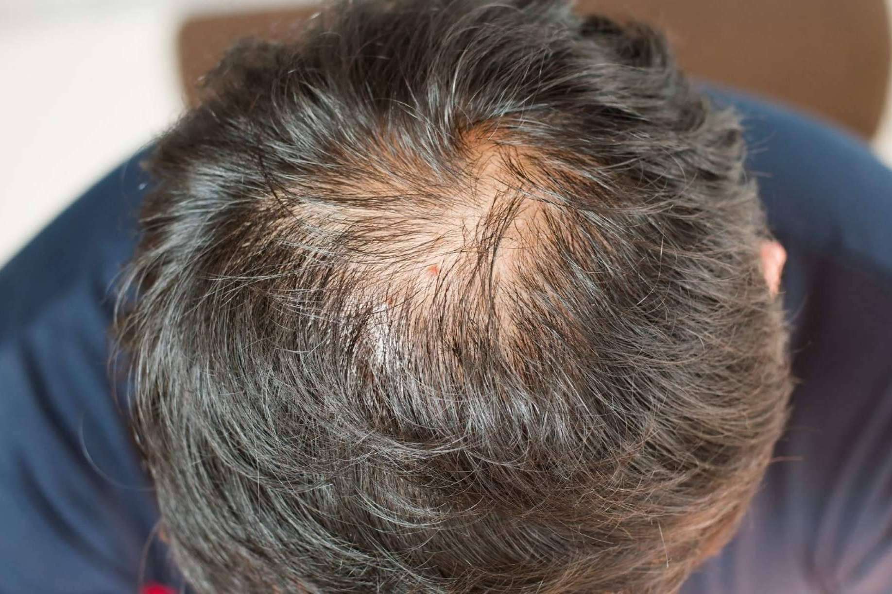 Combatir la caída del cabello con los péptidos de cobre de Kmax