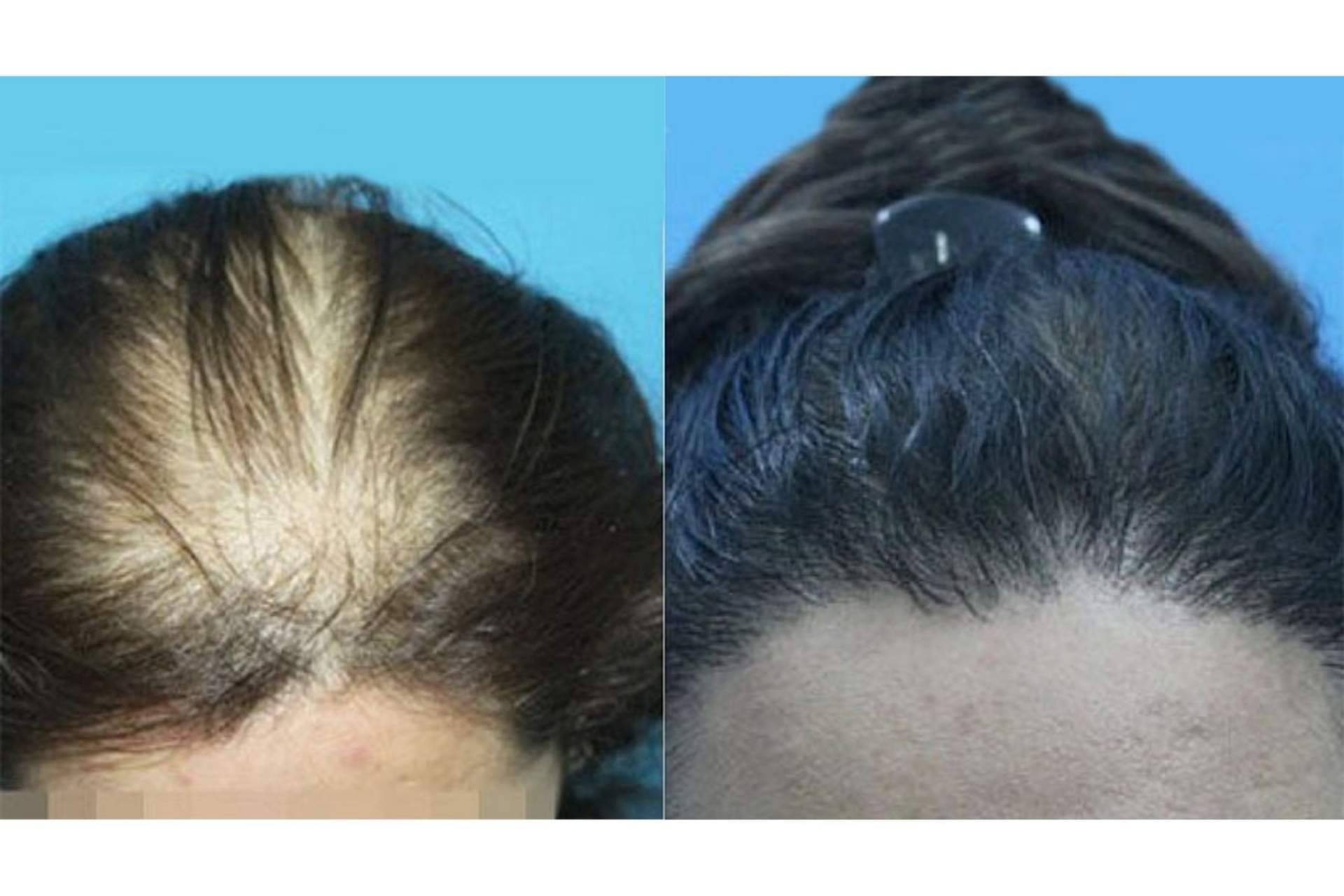 Trasplante capilar para mujeres que padecen alopecia femenina, por Innovación Capilar