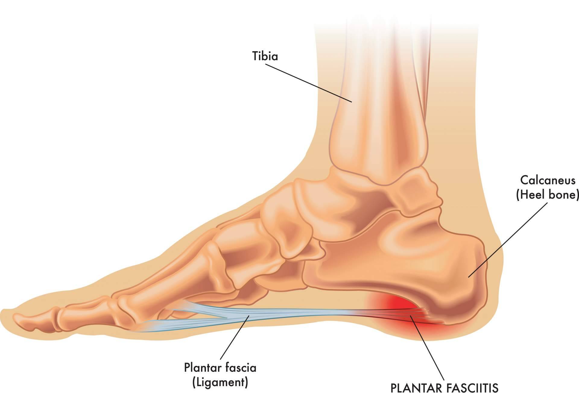 Sesiones de 8 minutos que mejoran la fascitis plantar en un 93 %