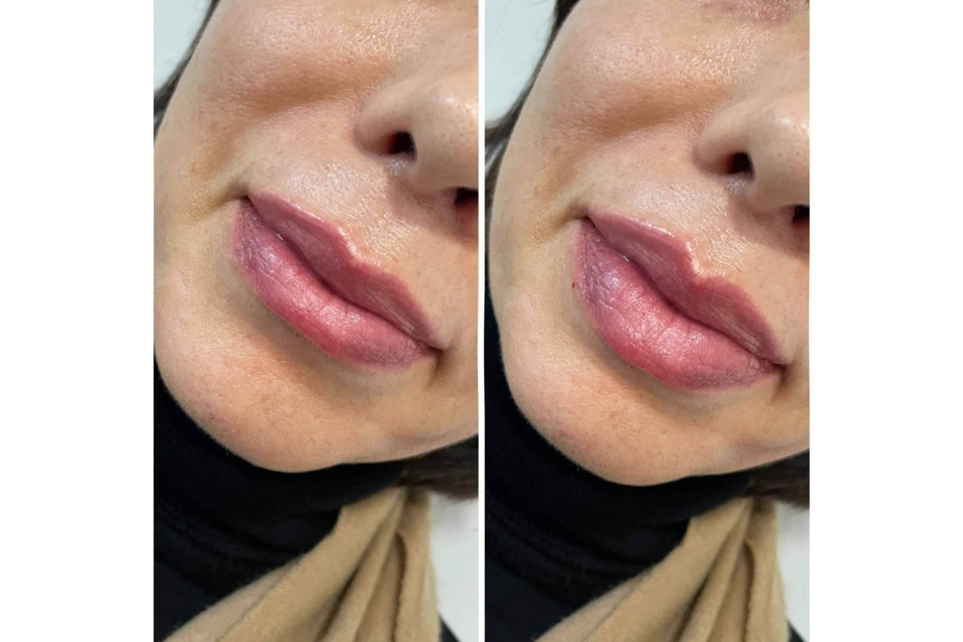 ¿Se puede conseguir un aumento de labios en Madrid con resultados naturales?, por la Dra. Cecilia Arthur