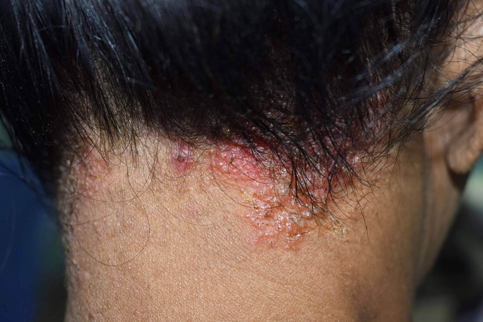 Una afección que puede provocar alopecia si no se trata es la dermatitis seborreica