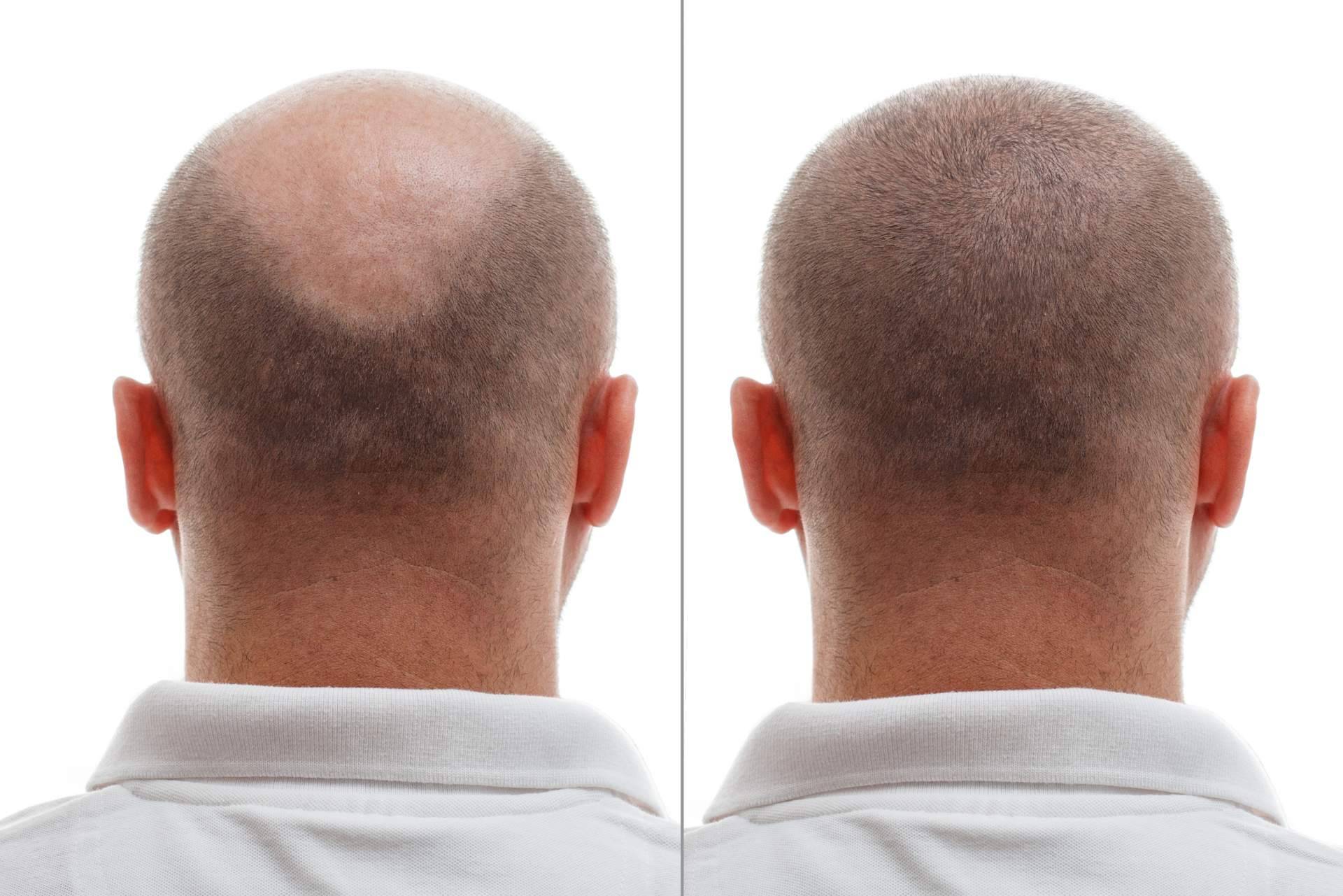 Trasplante de pelo en la coronilla, la solución definitiva para la alopecia en esta zona