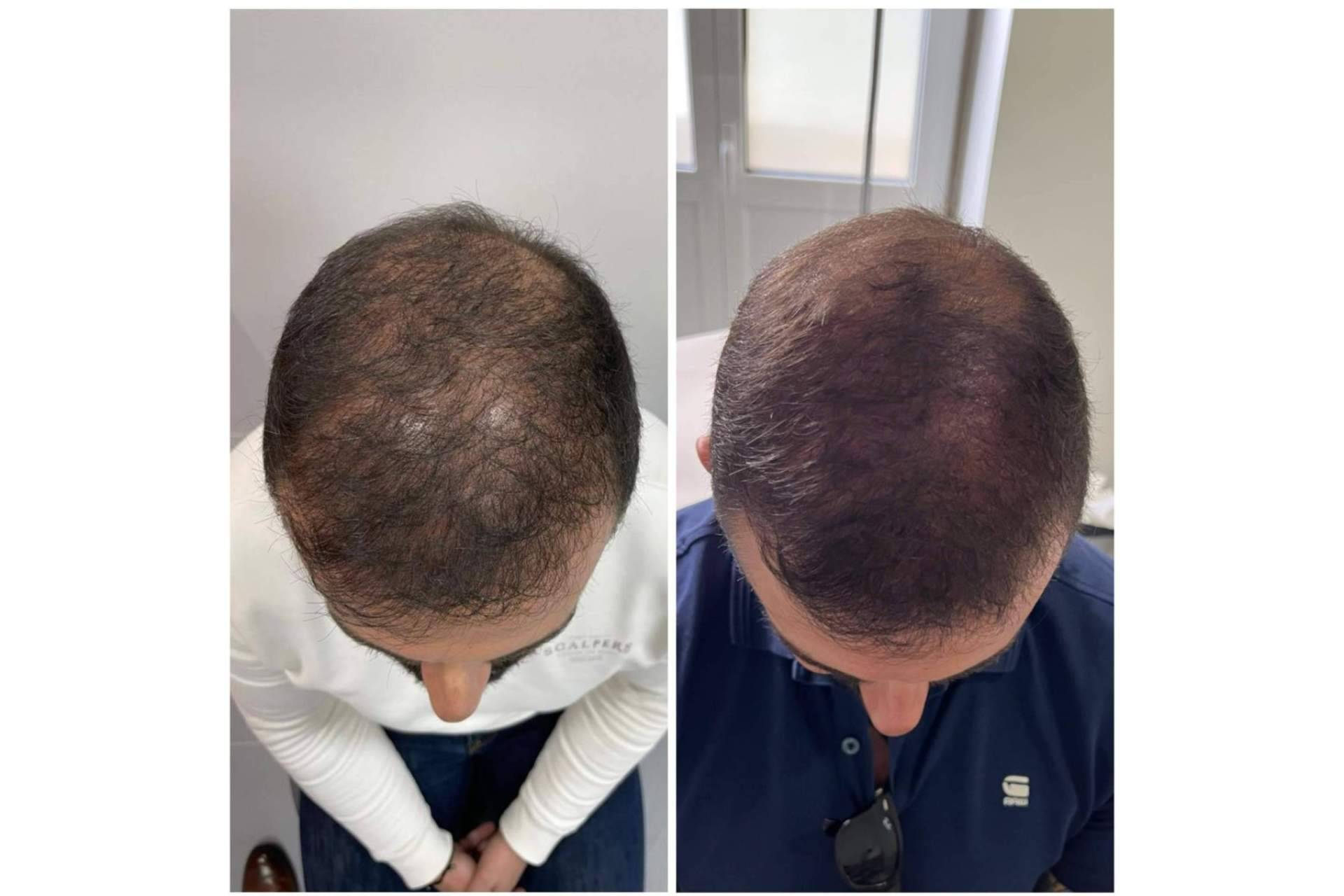 Cecilia Arthur y sus tratamientos para la caída de pelo