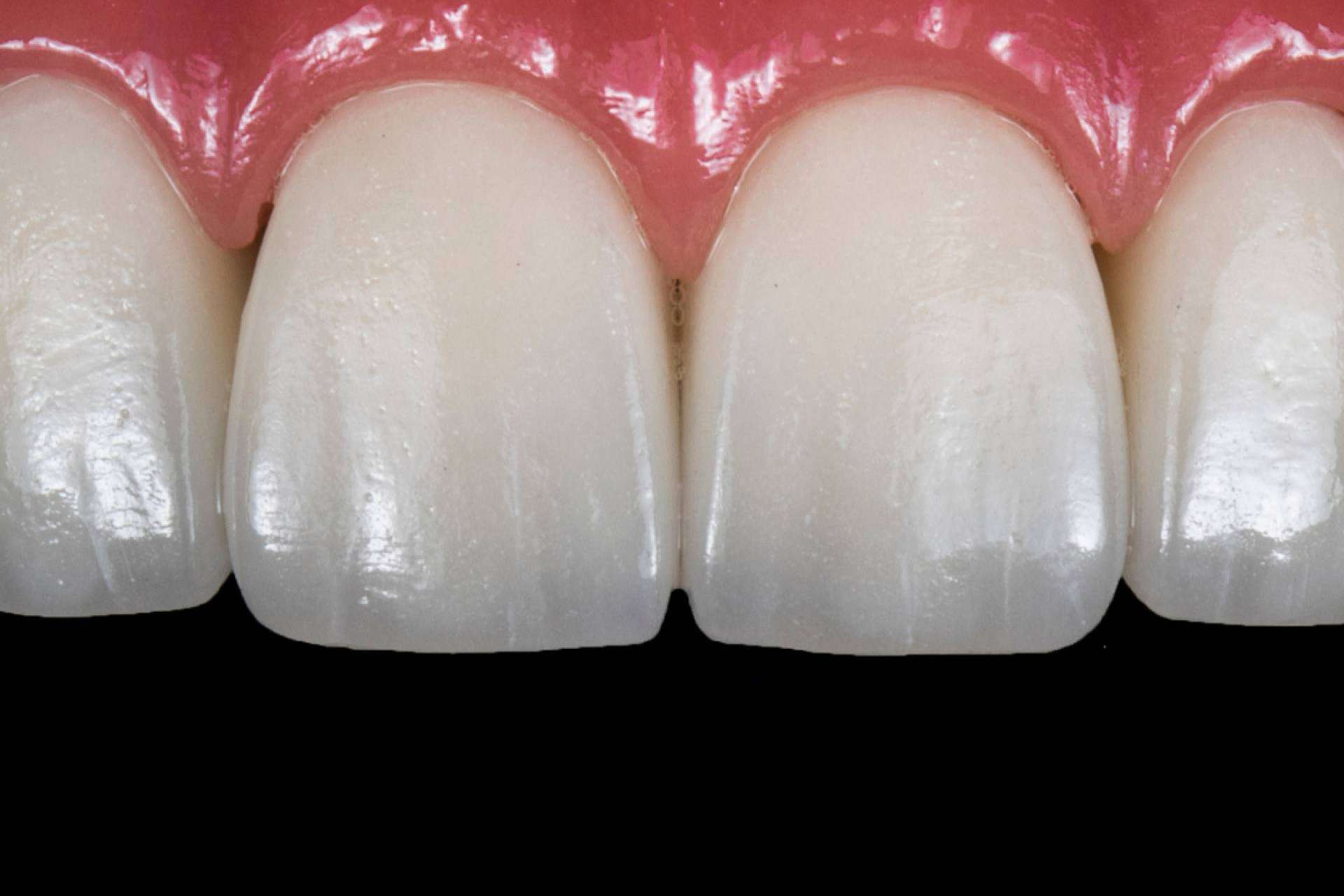 Corporación Dental pone implantes de carga inmediata en Antequera