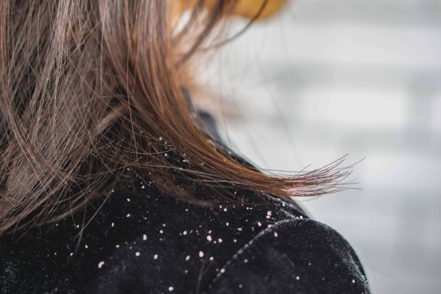 La caspa podría ser culpable de la caída del cabello