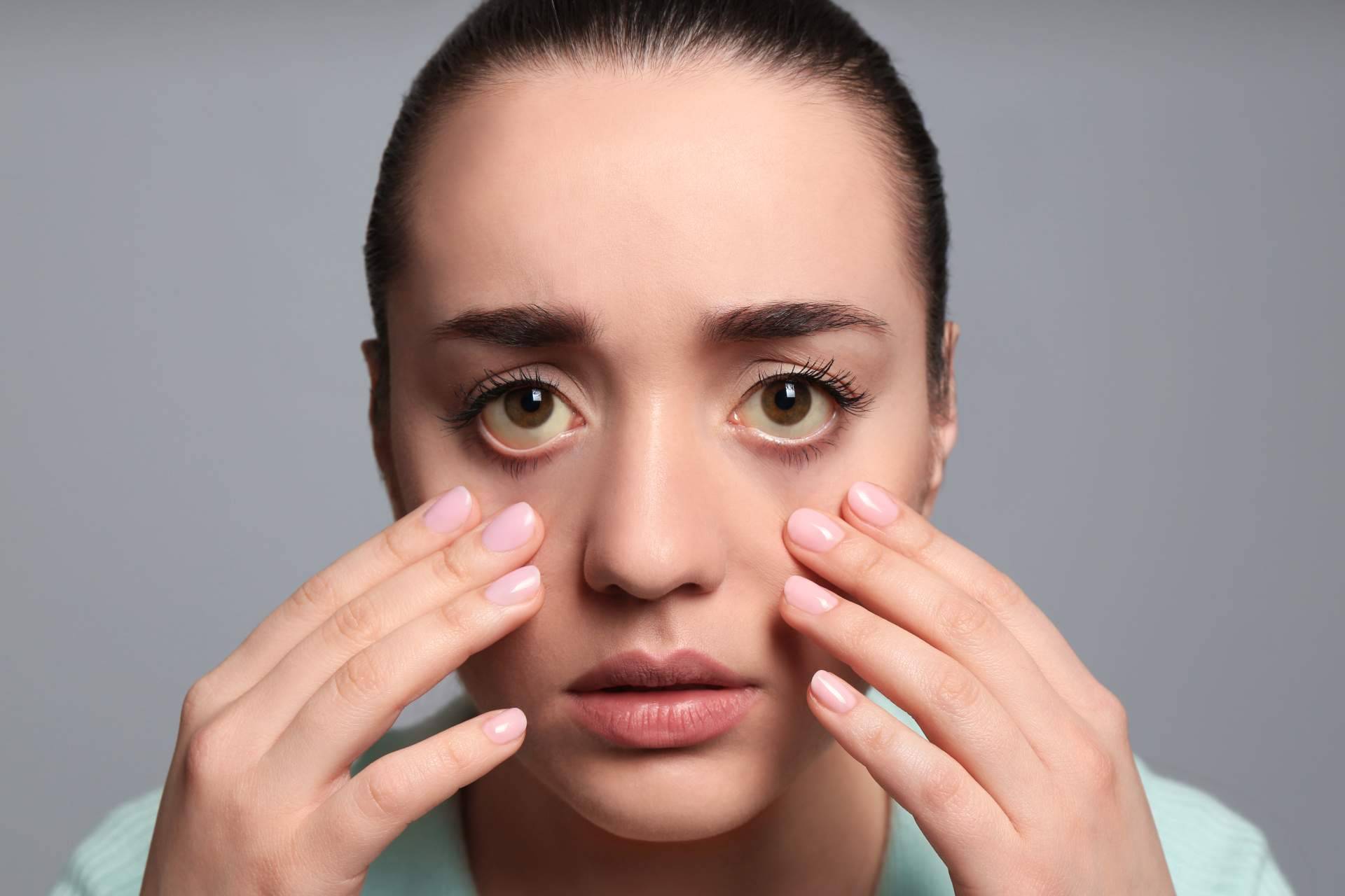 Las causas de los ojos amarillos y dónde tratarlos, explicado por el Instituto Oftalmológico Dexeus