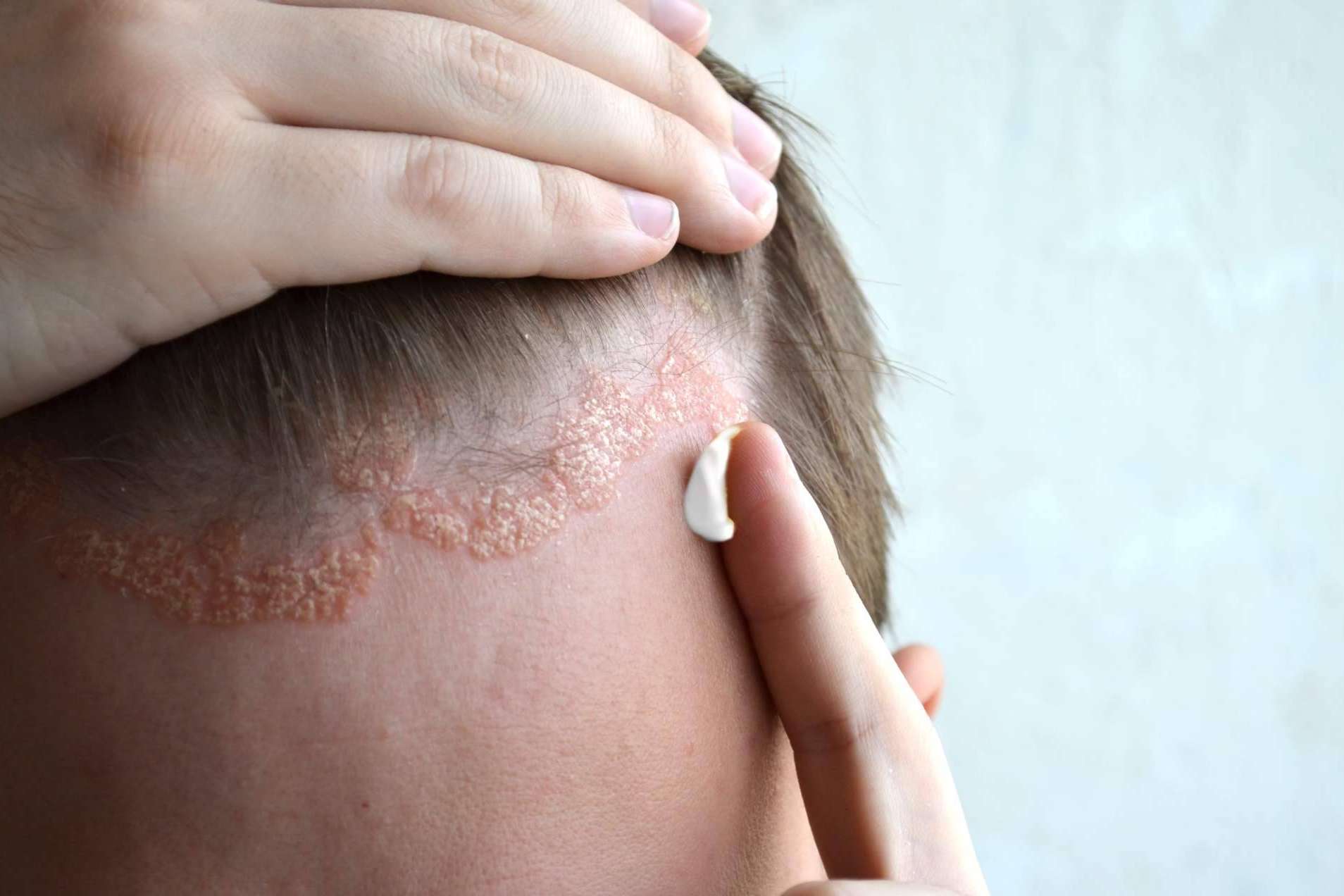 Los riesgos que hay sobre la psoriasis en cuero cabelludo, según la Fundación Piel Sana de la AEDV