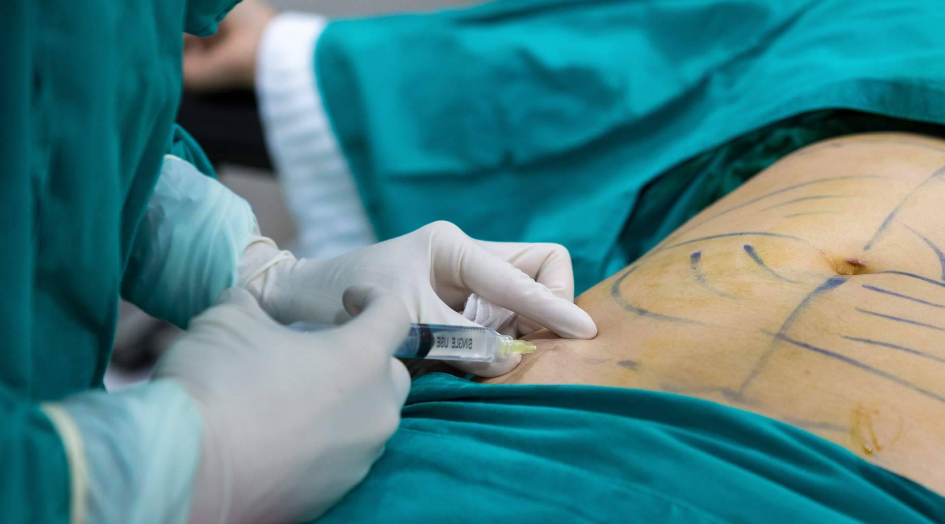 A2Clínic sobre los beneficios de la lipoescultura