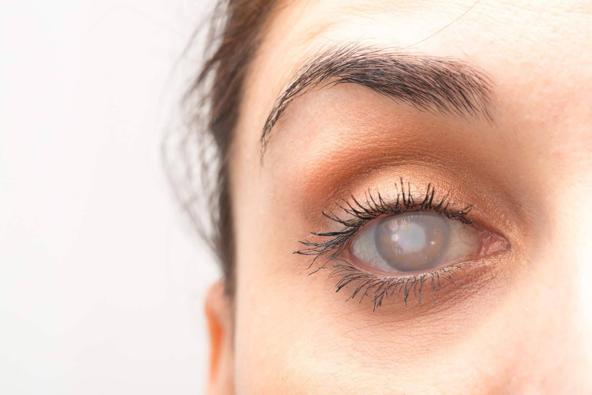 El uso de lentes intraoculares para tratar las cataratas