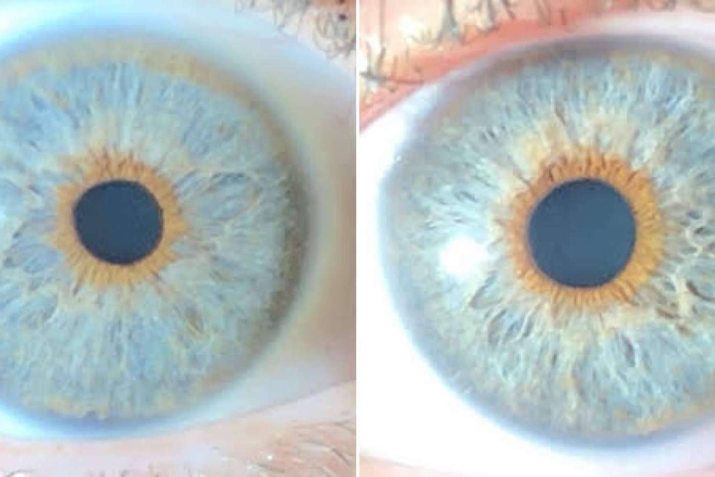 Los avances en las operaciones de cambio de color de ojos con láser, de la mano de Clínica Eyecos