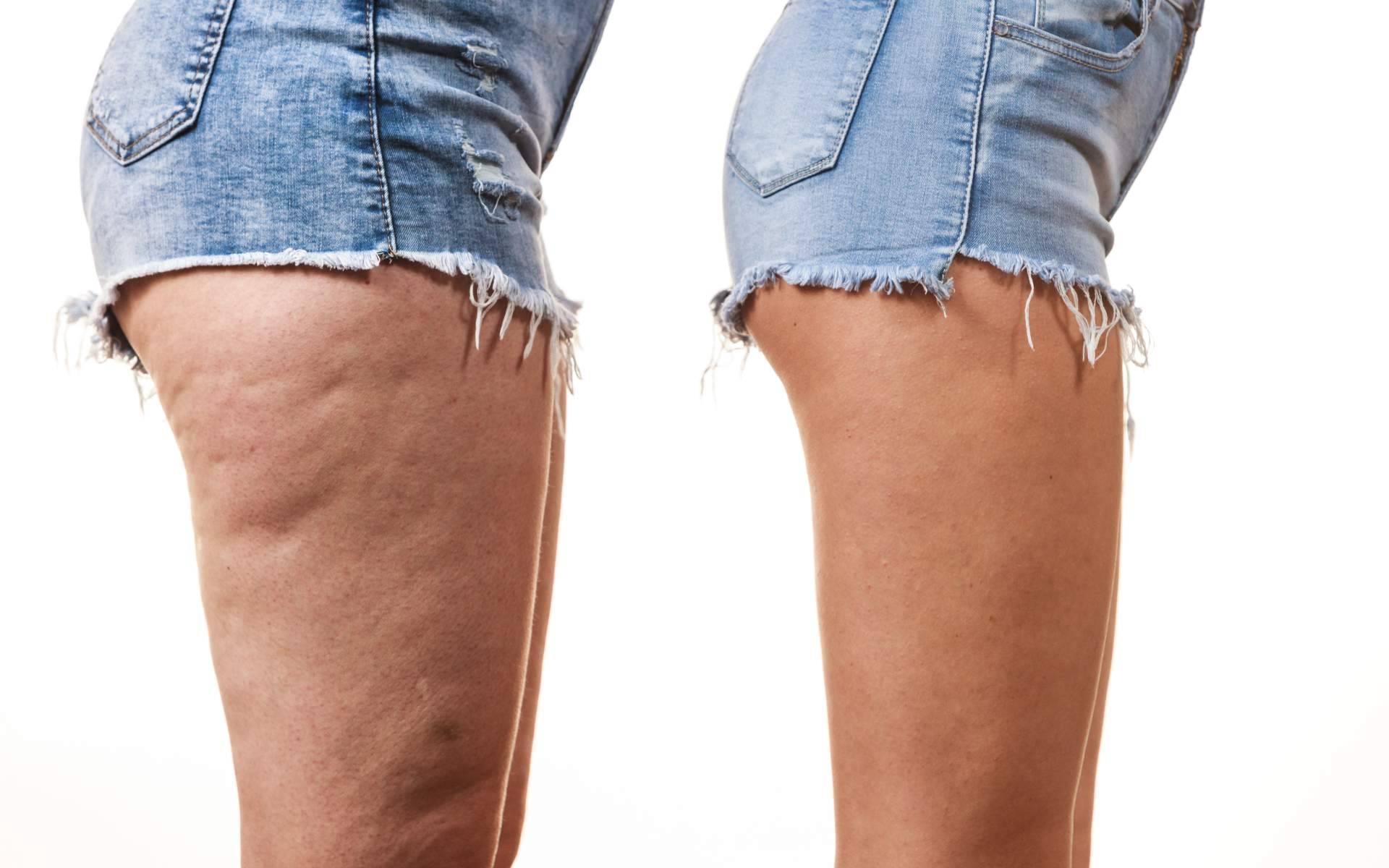 Vacuslim 48, tratamiento corporal para reducir la celulitis, disponible en Mesmerie