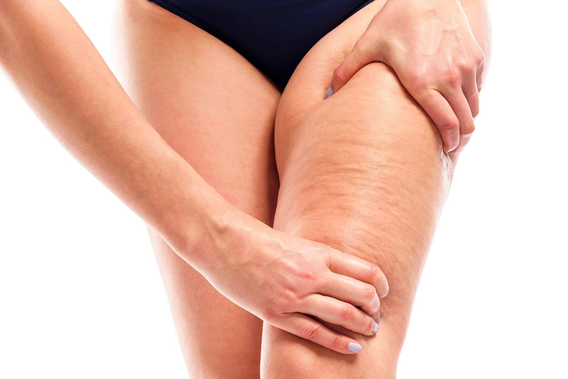 ¿Realmente funciona? Vacuslim 48, tratamiento corporal para tratar y reducir la celulitis