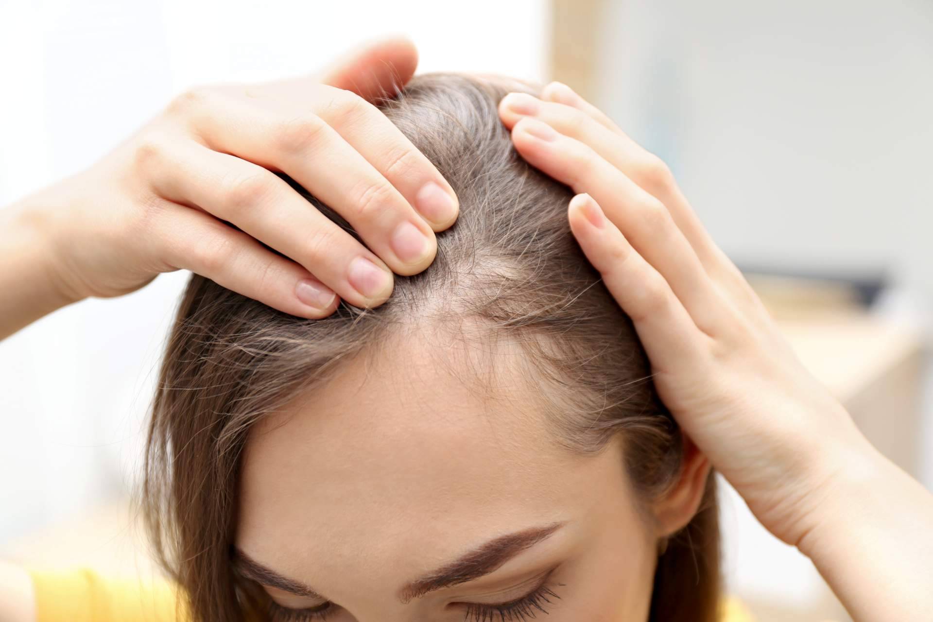 ¿Cómo combatir la alopecia femenina? El método de Capilar Innovation Clinic