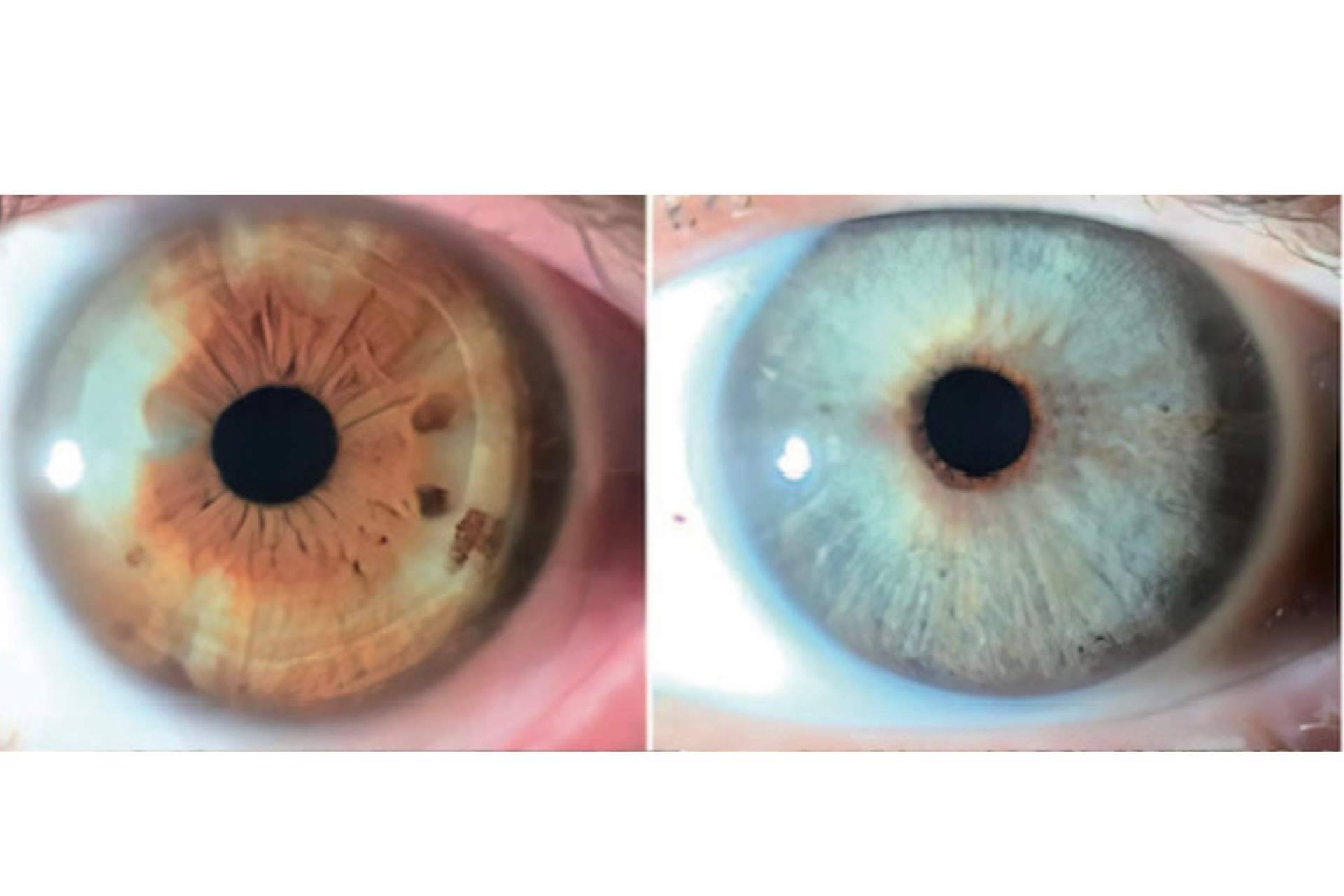 ¿Los heterocromías y los nevus del iris pueden ser tratados con láser? Clínica Eyecos