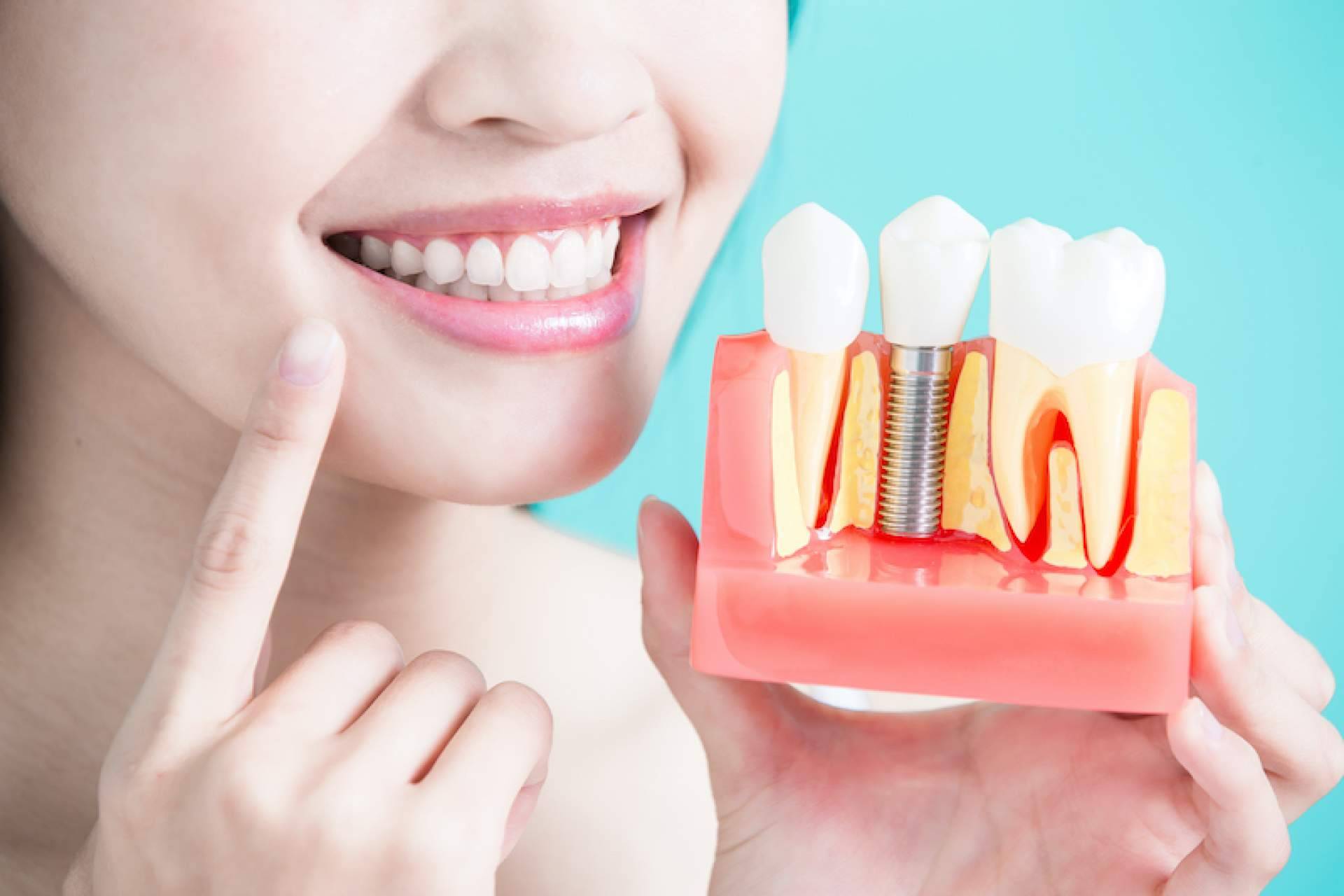Clínica dental Samprodent, especialista en implantes personalizados con materiales de primera calidad