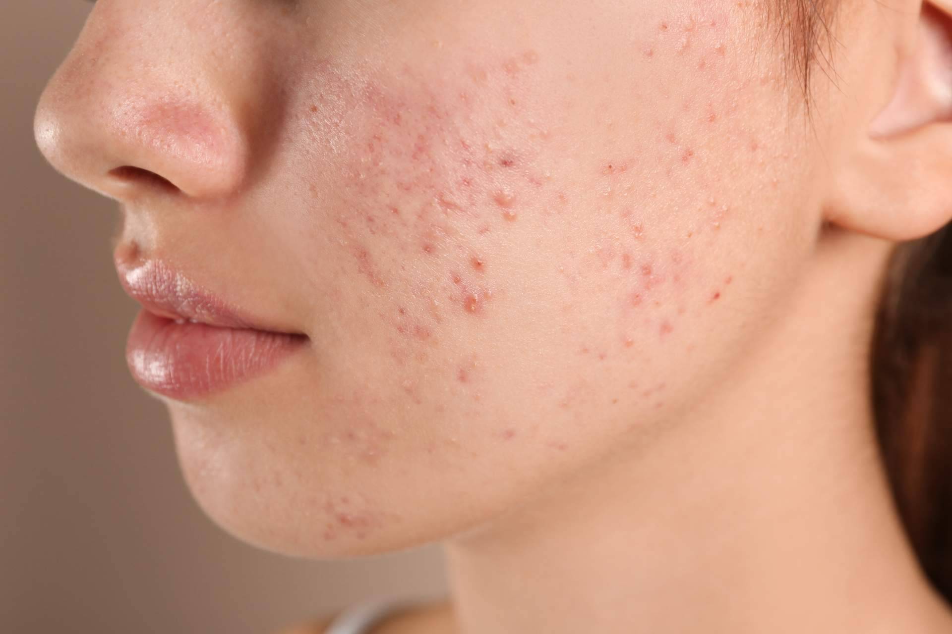 Alluring Clinic, tratamiento de cicatrices de acné con radiofrecuencia fraccionada con microagujas
