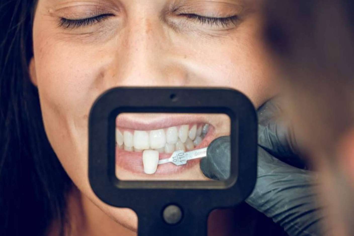 Clínica Dental Ruiz de Gopegui explica los beneficios de las carillas de composite