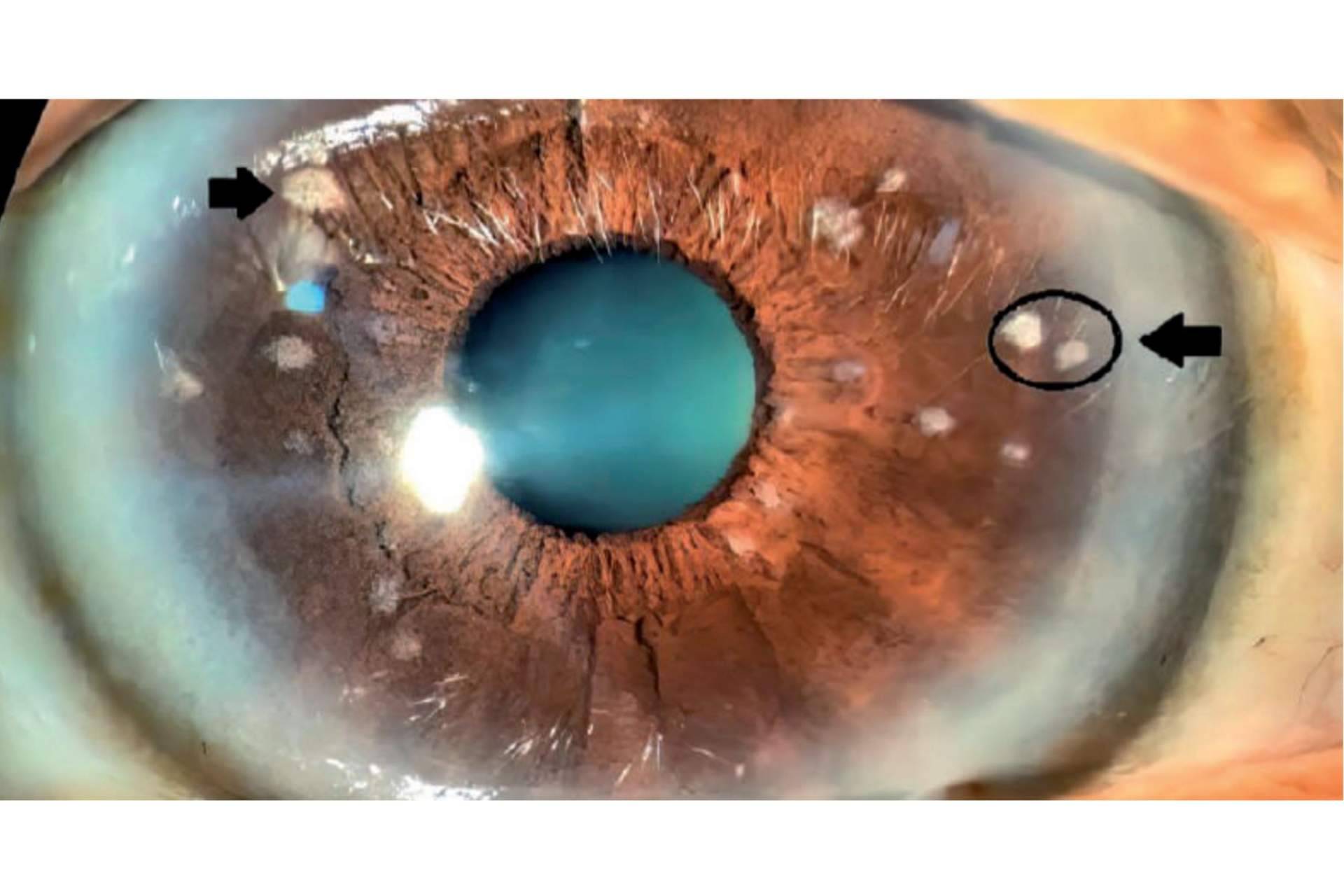Iridoplastia láser; una opción para el tratamiento del vitiligo ocular