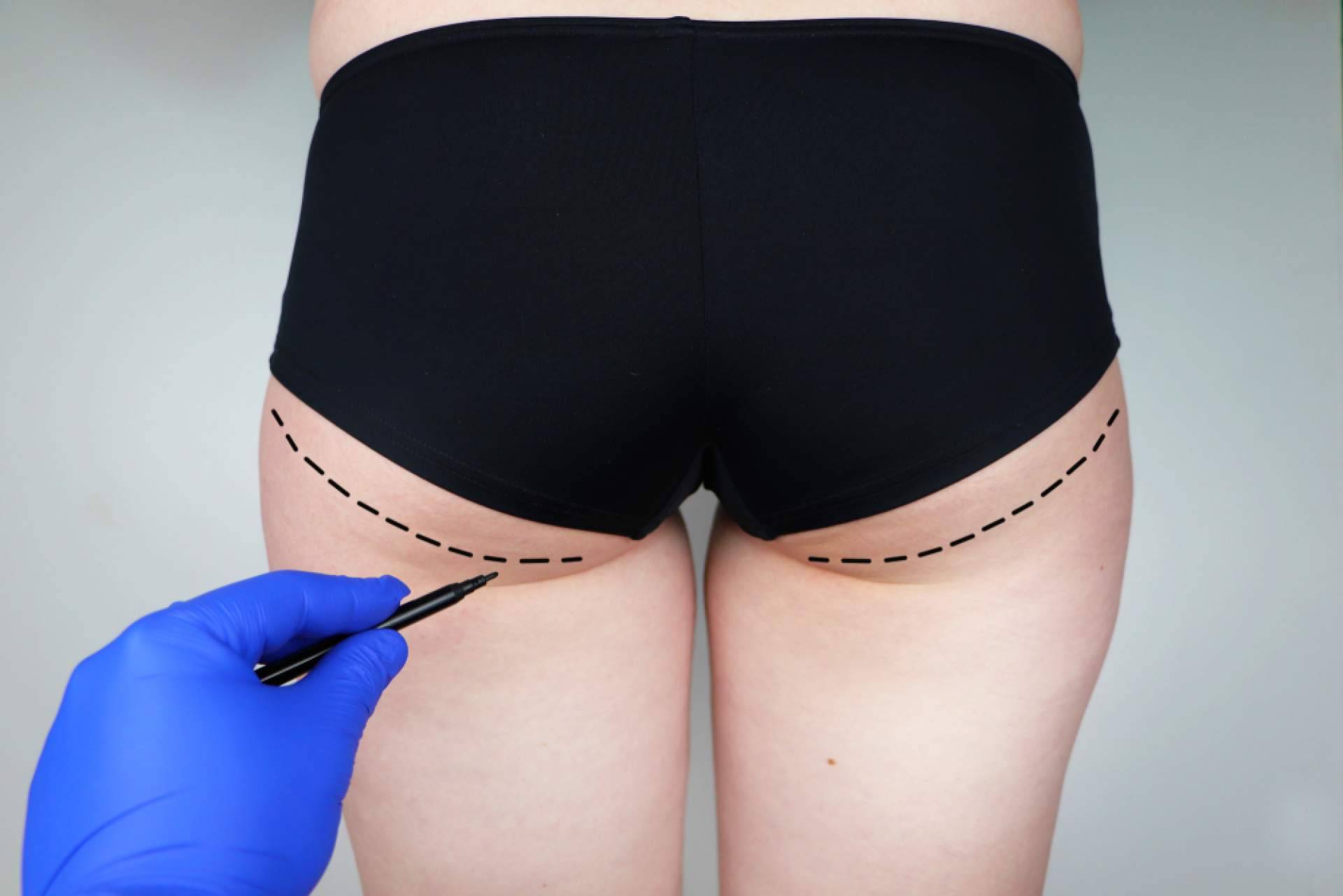 Gluteoplastia en Canarias con las técnicas avanzadas del Dr. Julián Castillo