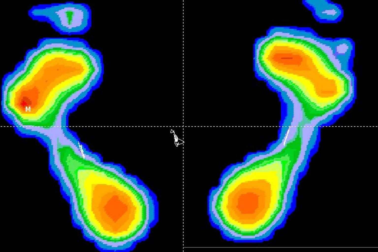 ¿Por qué es importante un estudio biomecánico en el deporte? Clínica Podológica M.O.