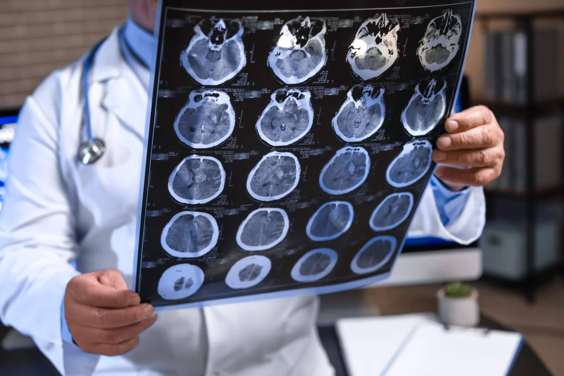 Clínica DKF innova en el tratamiento del Alzheimer en fase temprana