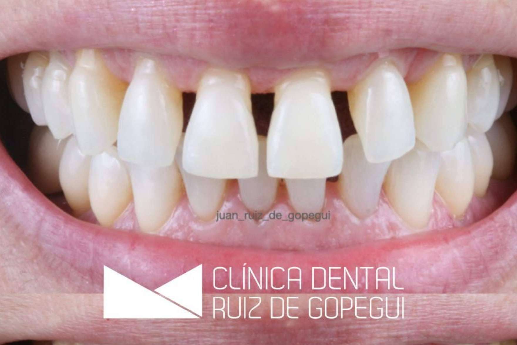 La periodontitis, una enfermedad silenciosa que necesita tratamiento