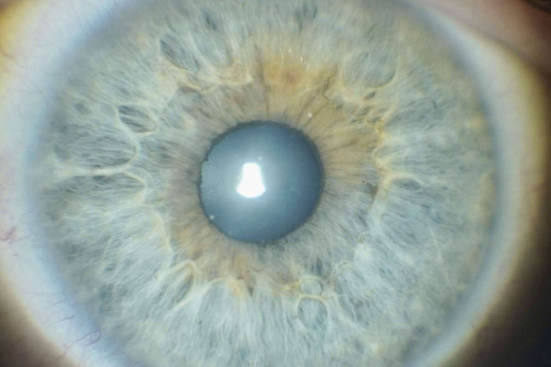 La revolucionaria iridoplastia láser en la Clínica Eyecos; cambio de color de ojos seguro, efectivo y natural