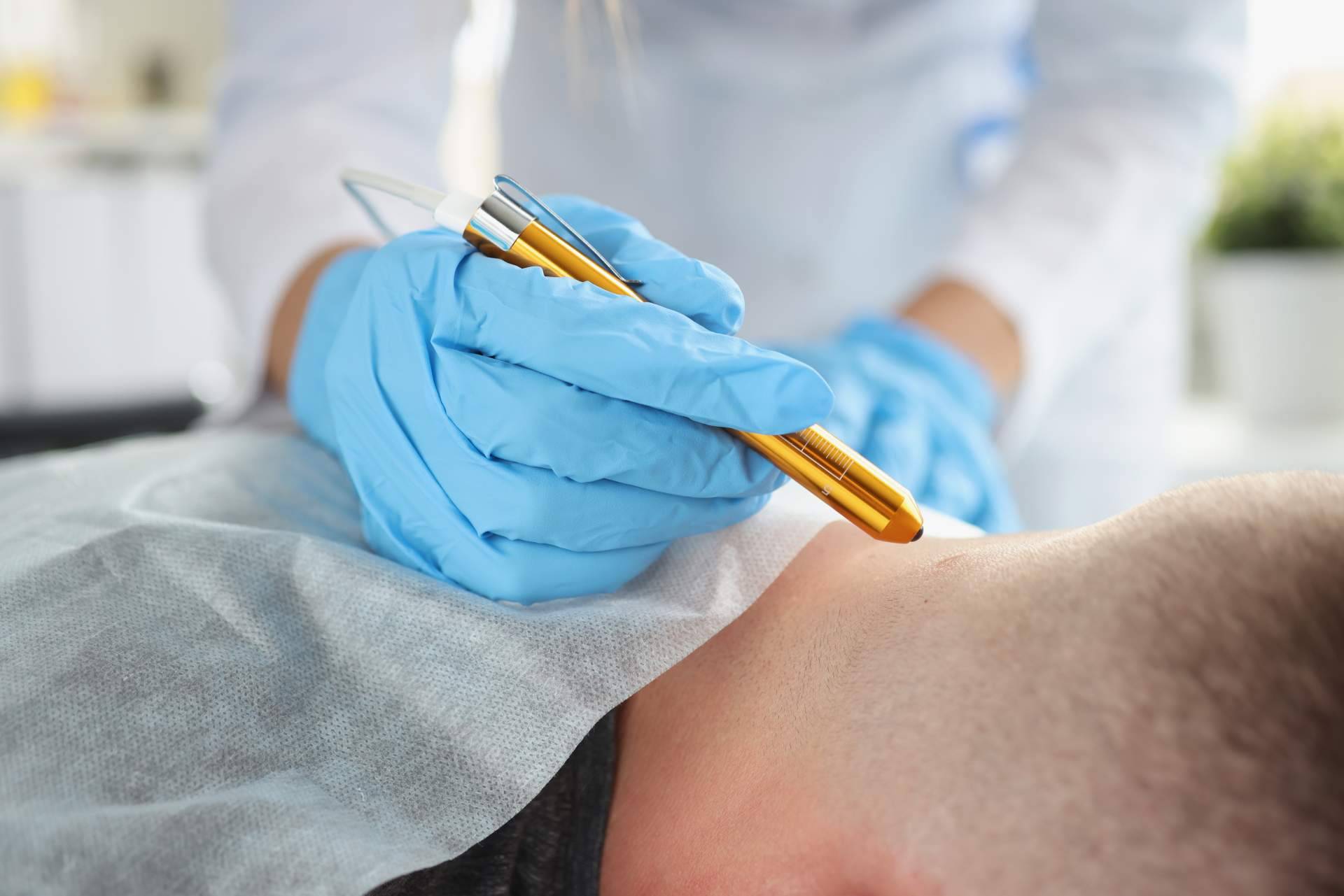 Eliminación de lunares y verrugas con los tratamientos más innovadores en Centro Estética El Pilar
