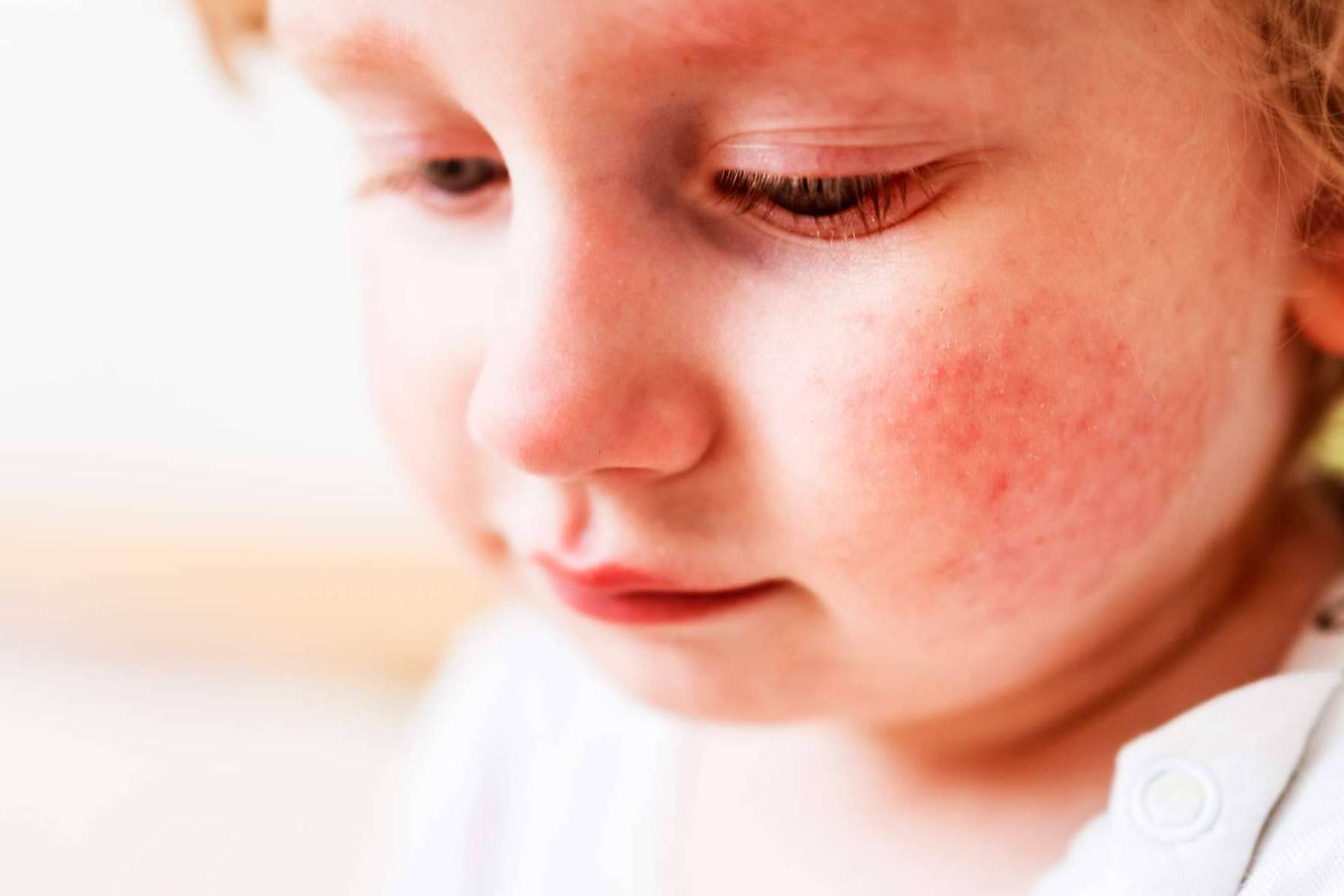 Los luchadores contra el eczema ahora cuentan con un superhéroe, Novopiel