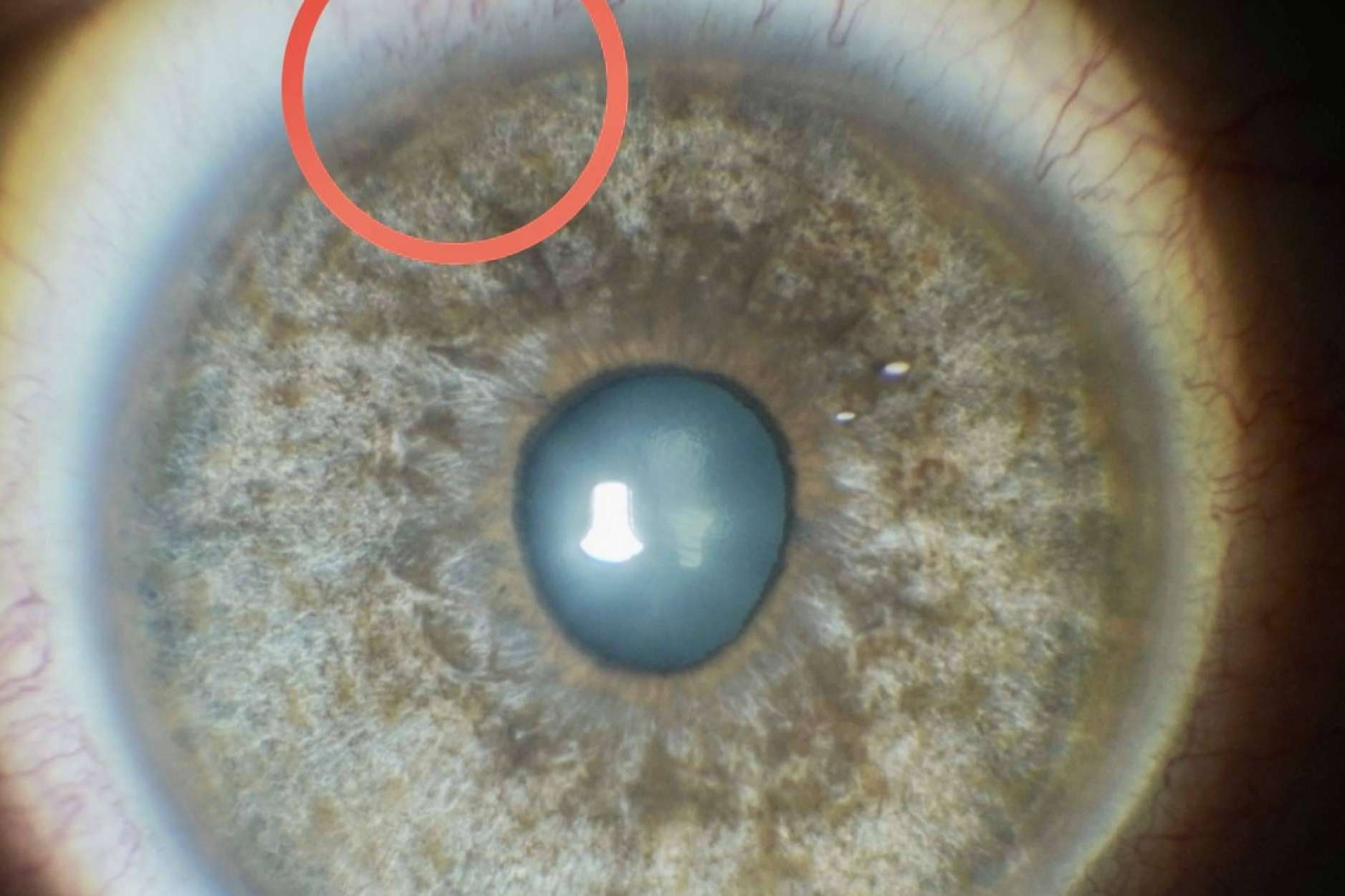 En qué consiste el tratamiento láser de las manchas pigmentarias de la conjuntiva