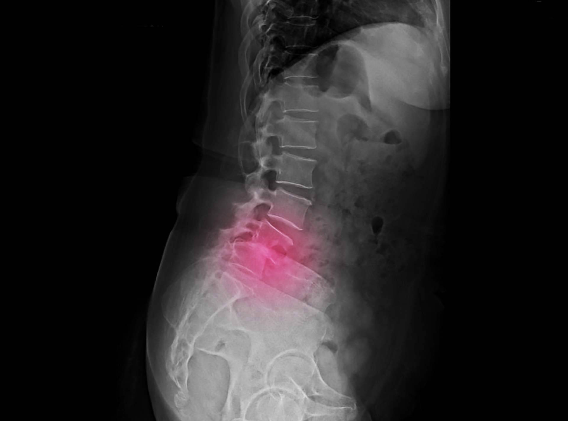 Las causas de la espondilolistesis, por iXalud