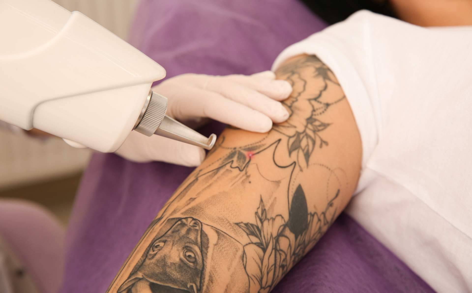 Eliminar tatuajes a color ya es posible de la mano de Ink Láser Alicante