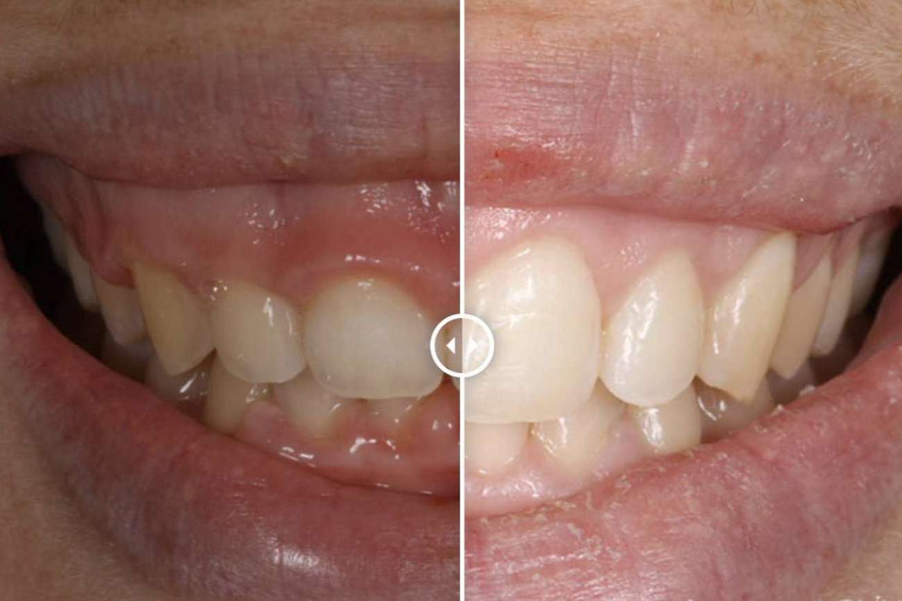 ¿De qué manera se puede corregir la sonrisa gingival?, por Clínica Dental Ruiz de Gopegui