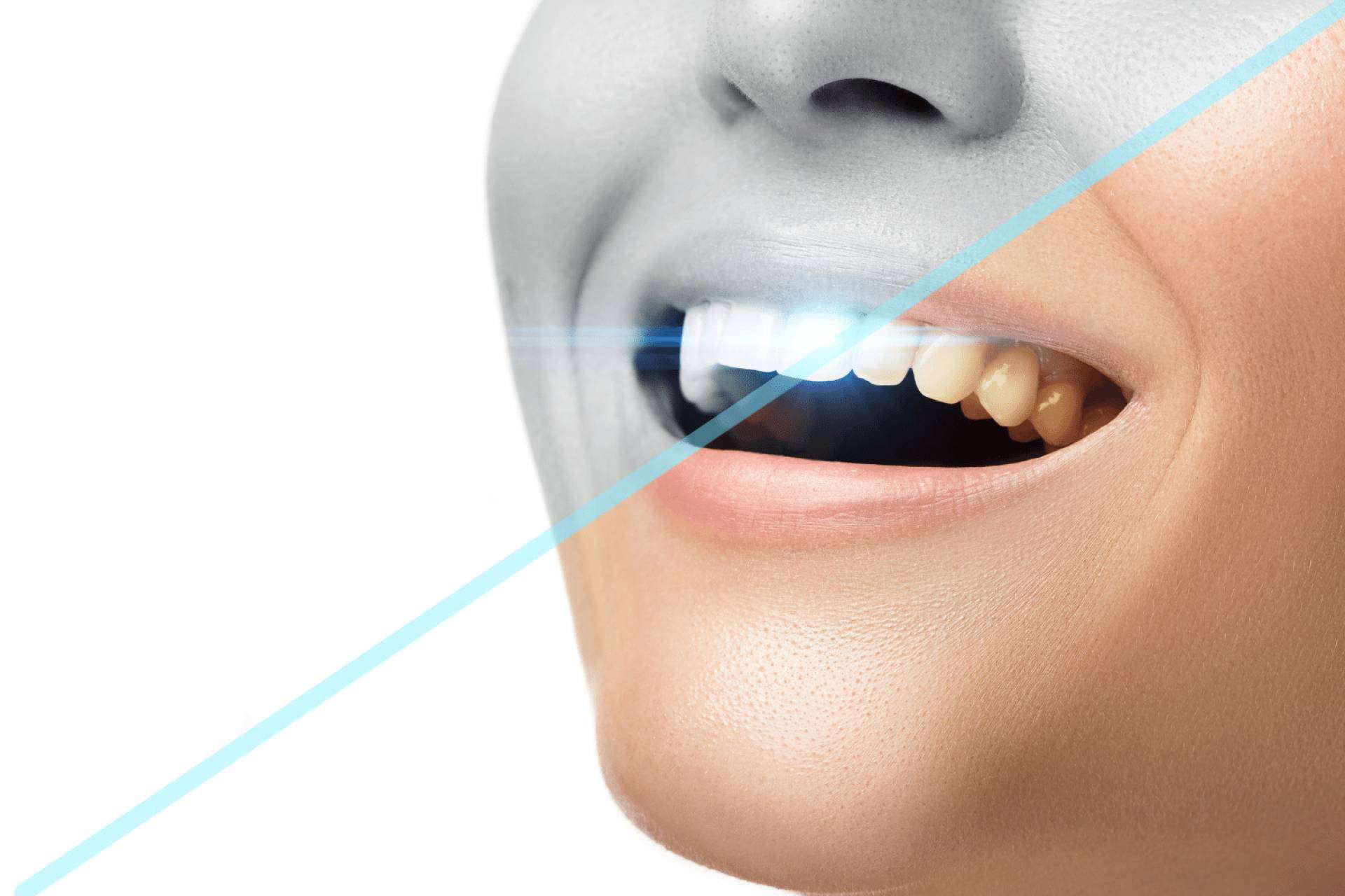 Ozonoterapia en odontología, una opción innovadora para la salud bucal