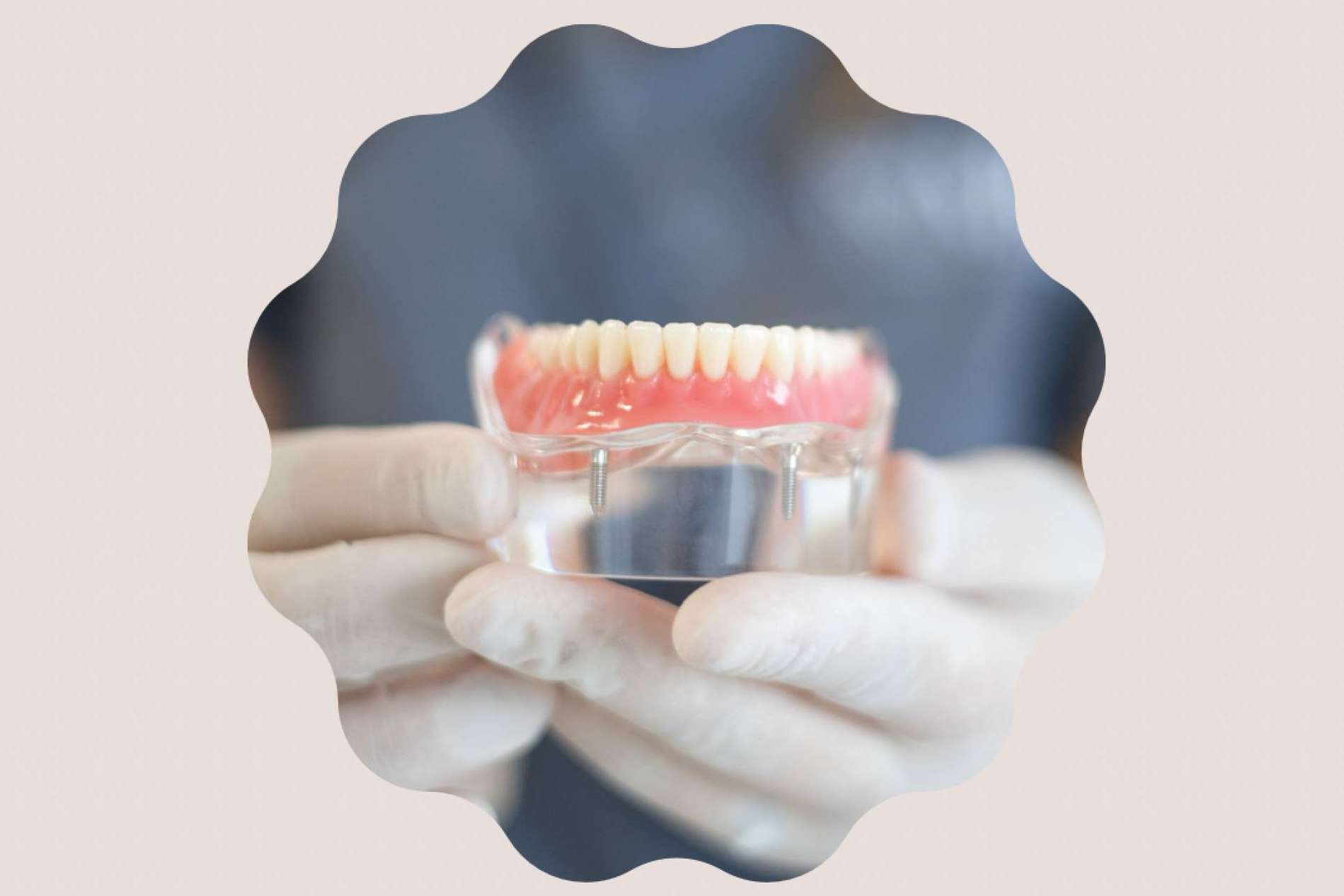 Tratamiento de implantología dental en Clínica MG Dental