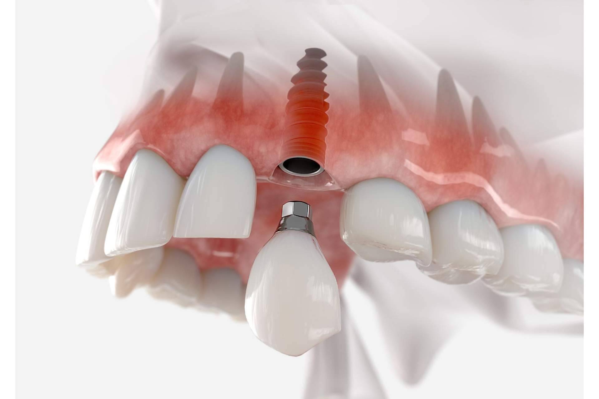 Servicios profesionales de implantología dental en Barcelona de la mano de Clínica Dental Arai