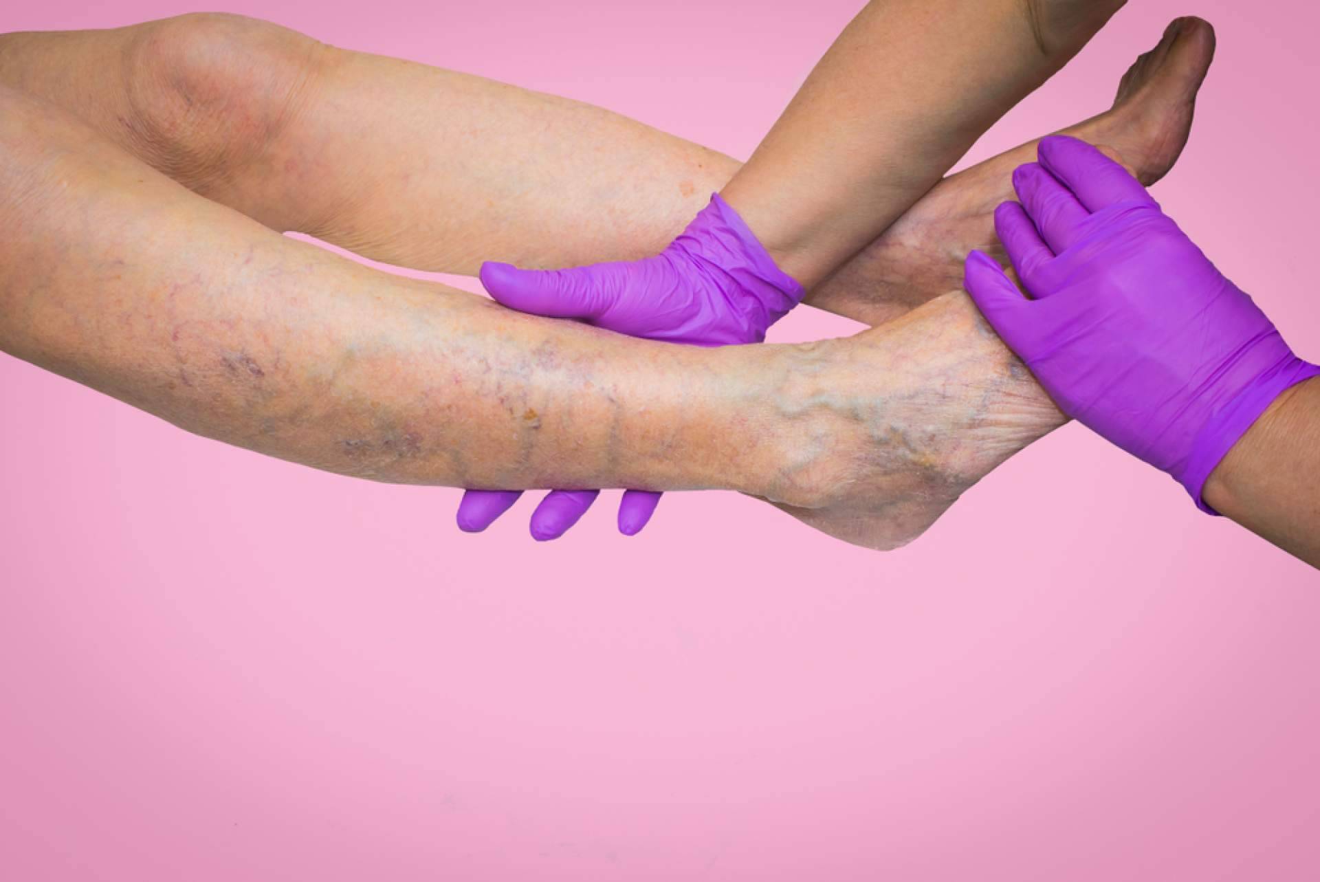 Eliminar arañas vasculares de la mano de Centro Estética El Pilar