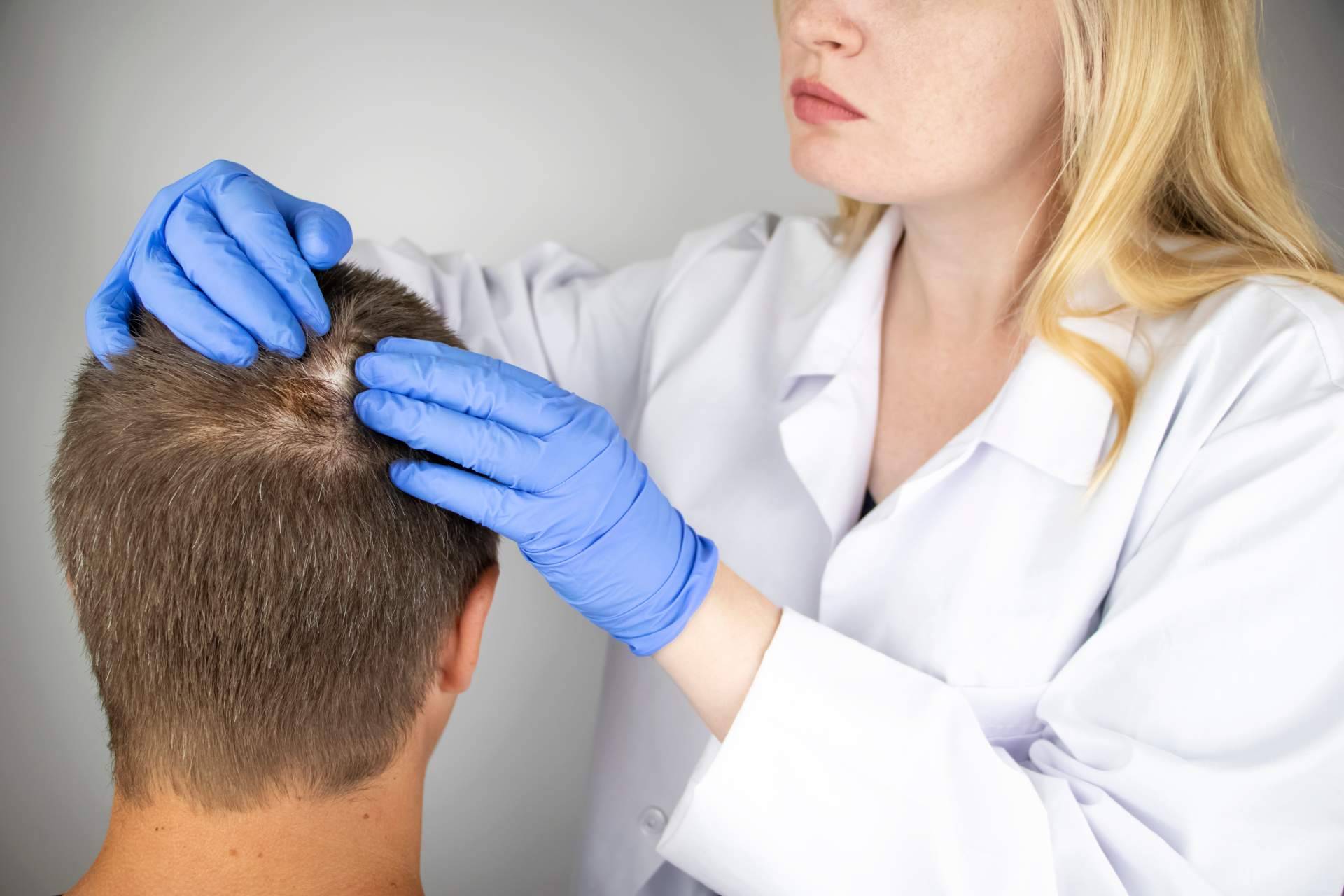 Saw Palmetto y los tratamientos para la alopecia androgénica