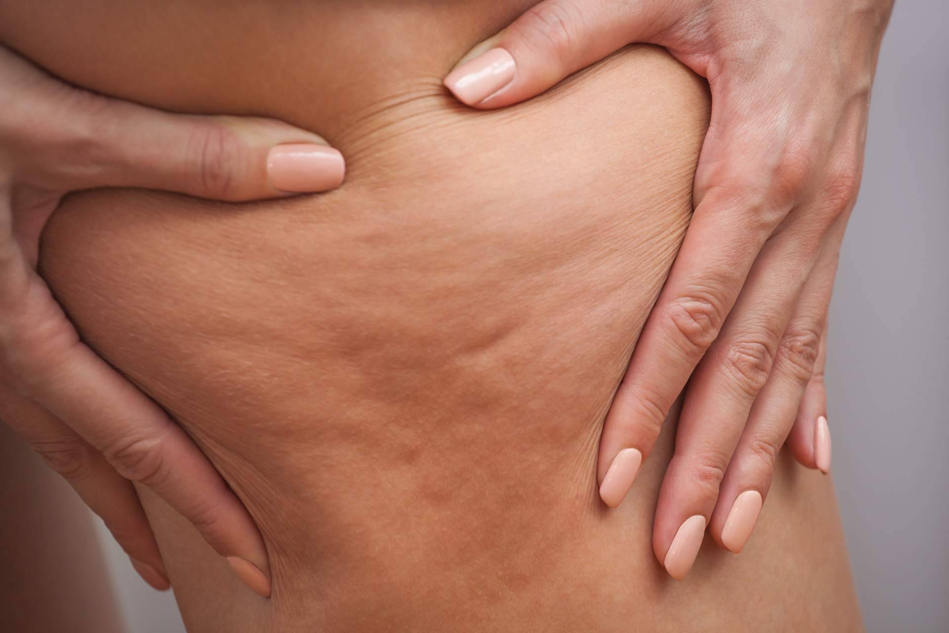 Cuerpo Libre y sus tratamientos anticelulíticos saludables