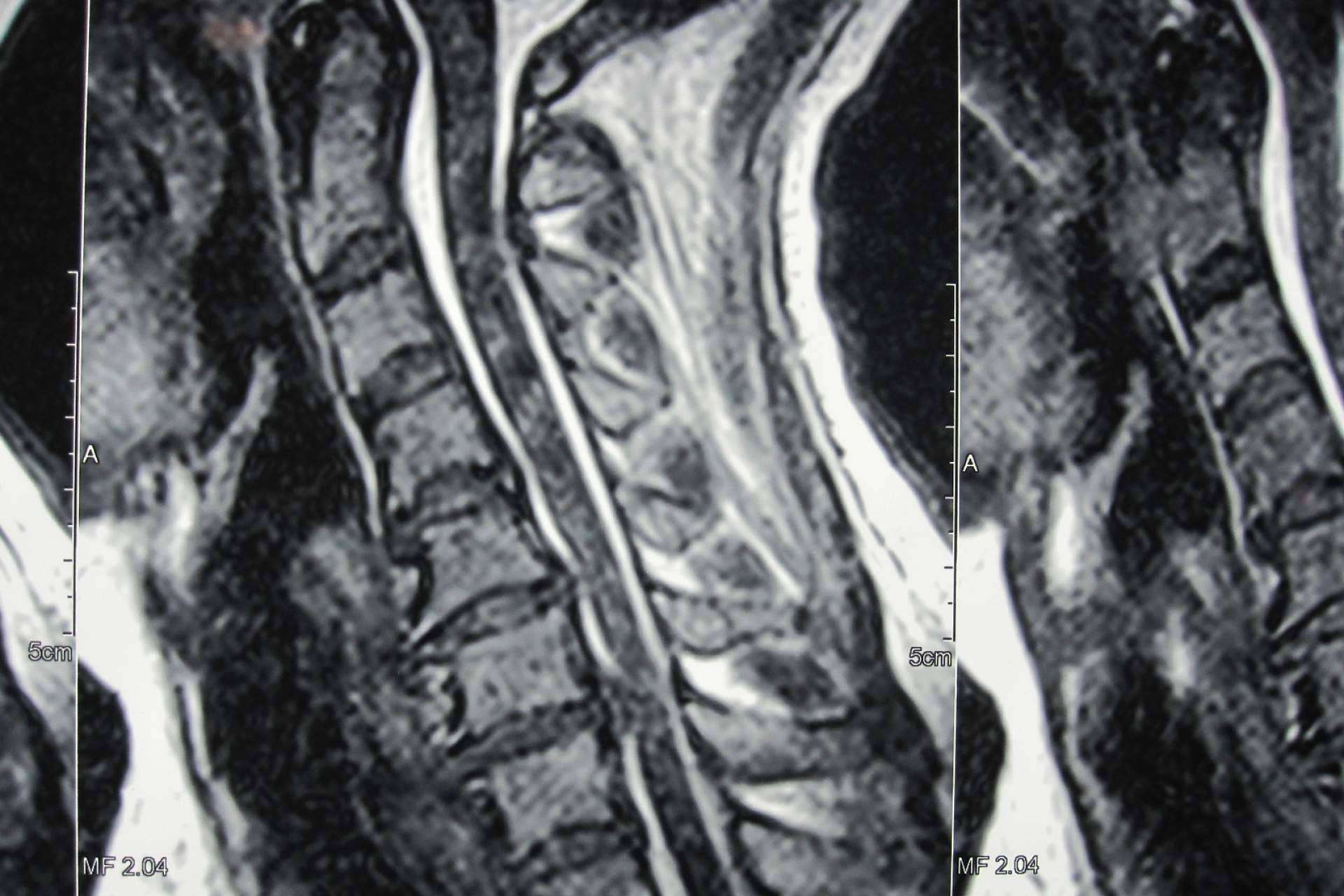 Neurocirugía Galarza informa sobre la hernia disco cervical