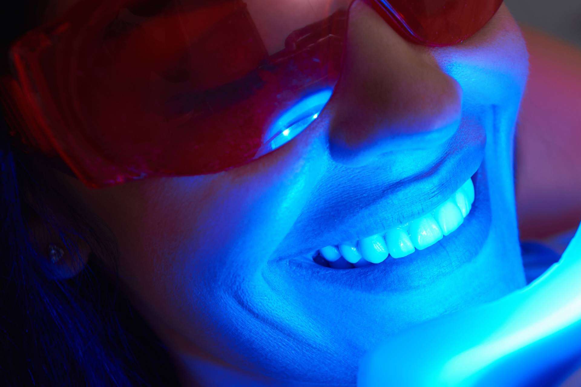 Blanqueamiento dental avanzado con luz LED para una apariencia radiante