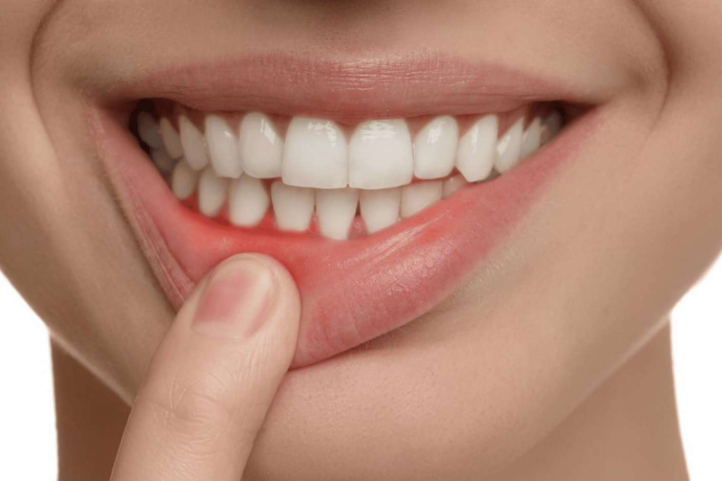 La Clínica Dental Ruiz de Gopegui explica cómo tratar la gingivitis