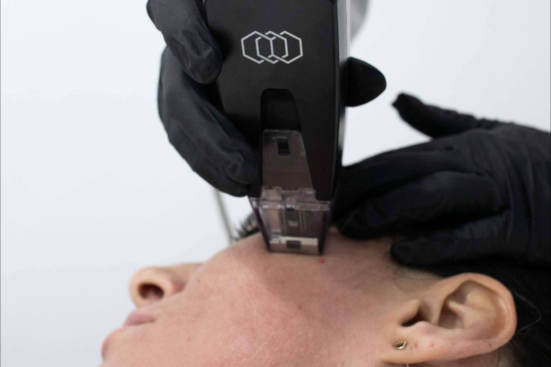Tratamiento rejuvenecedor Morpheus8 Facial y Corporal de la mano de la Clínica BK