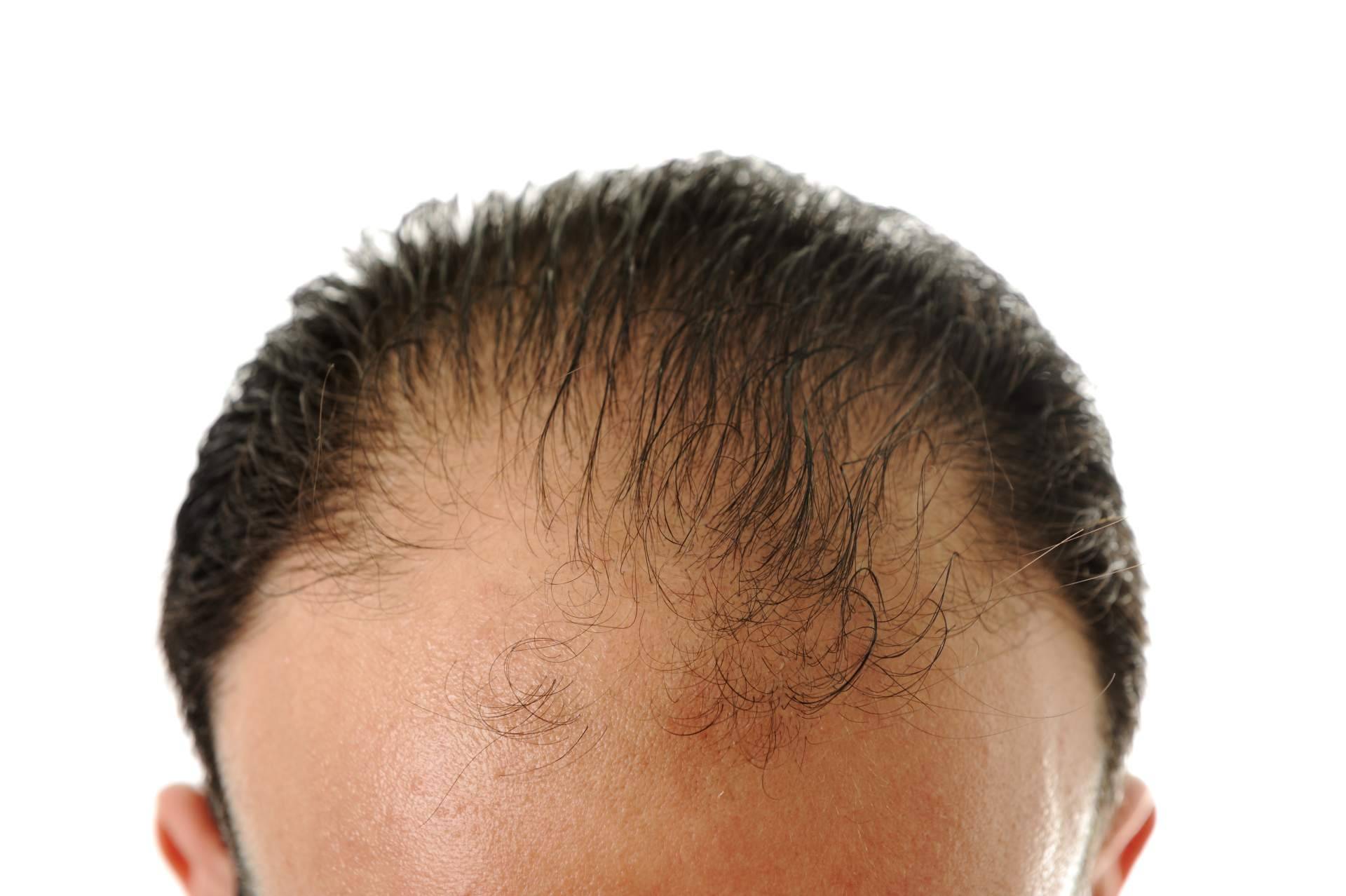 Contra la dermatitis seborreica, el champú Cleaner de Saw Palmetto