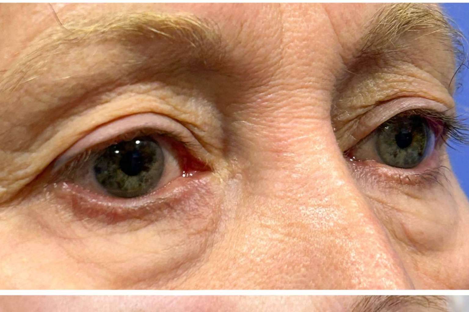 Rejuvenecimiento de la mirada con la ayuda de la cirugía estética