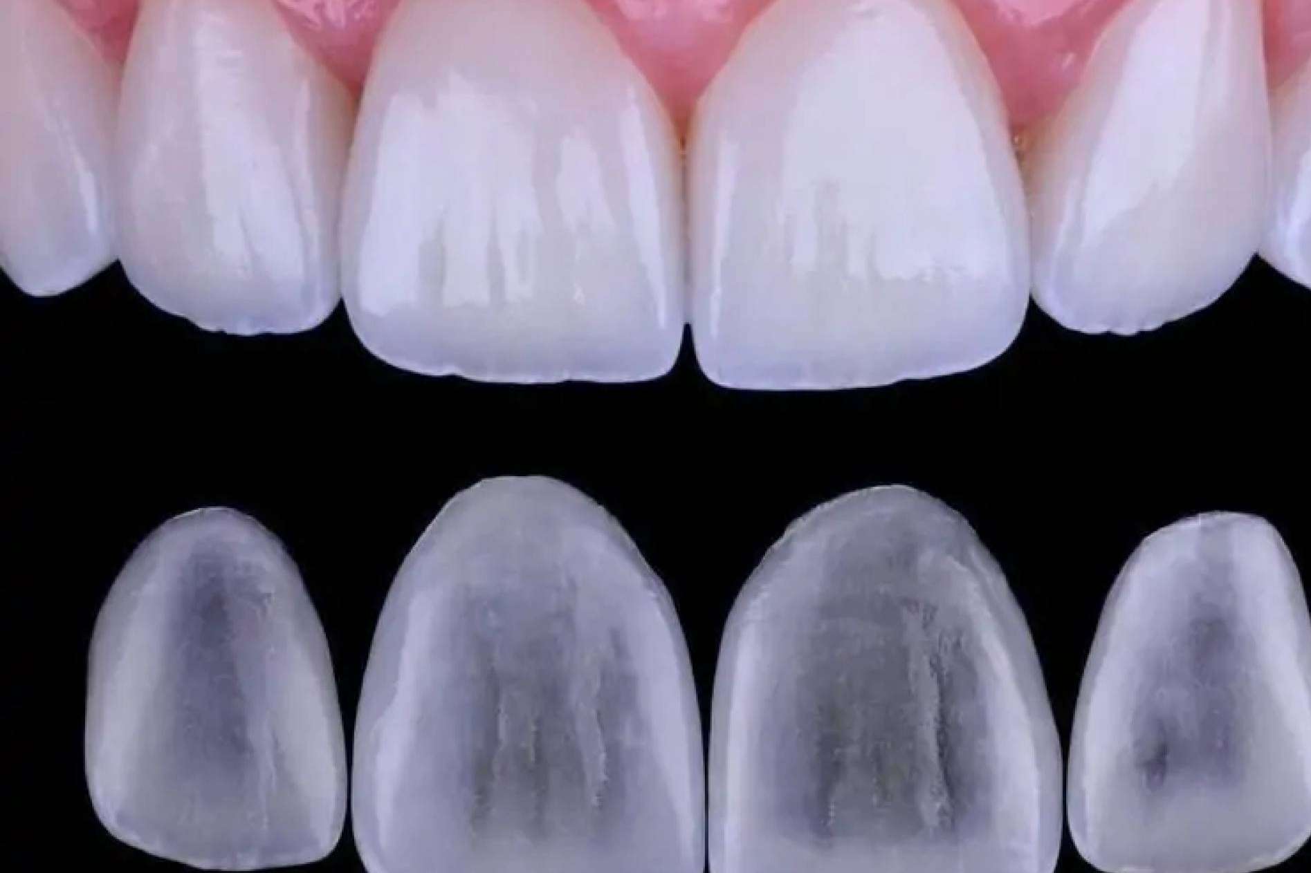 Cómo resolver una nueva sonrisa sin tocar el diente