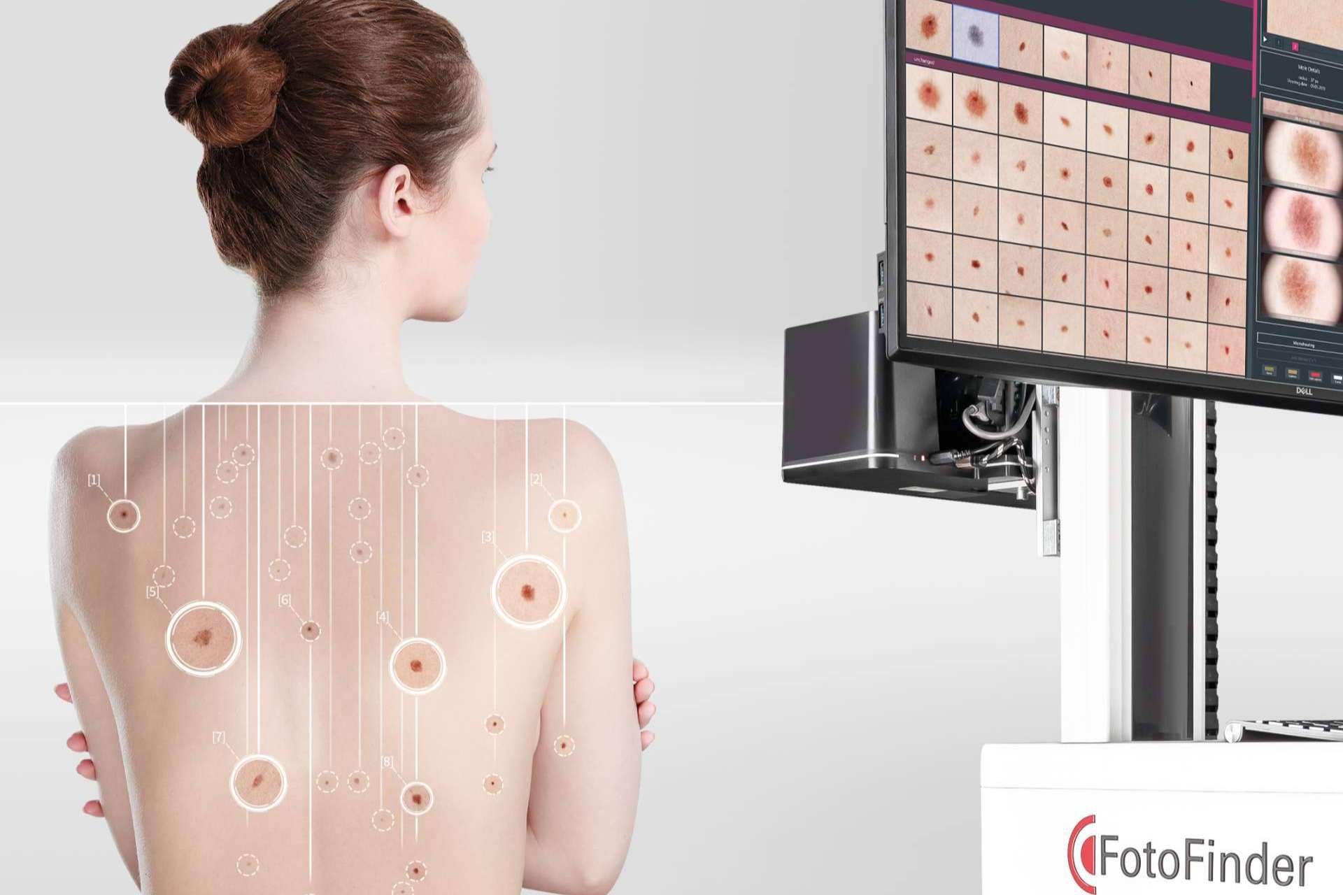 Los equipos FotoFinder incorporan la Inteligencia Artificial, para una dermatoscopia más precisa