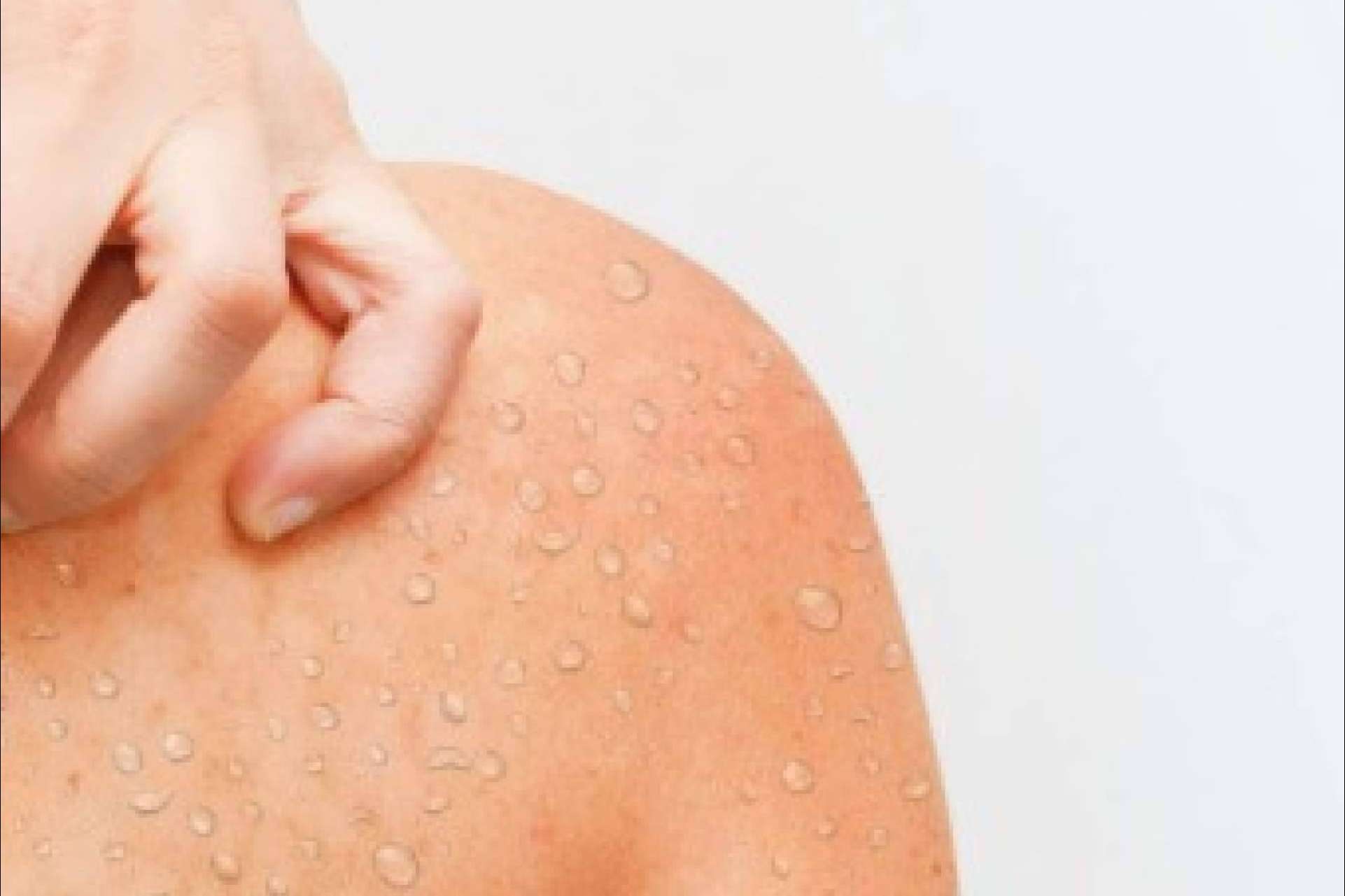 Verano y hongos en la piel; claves para reconocer y tratar la micosis