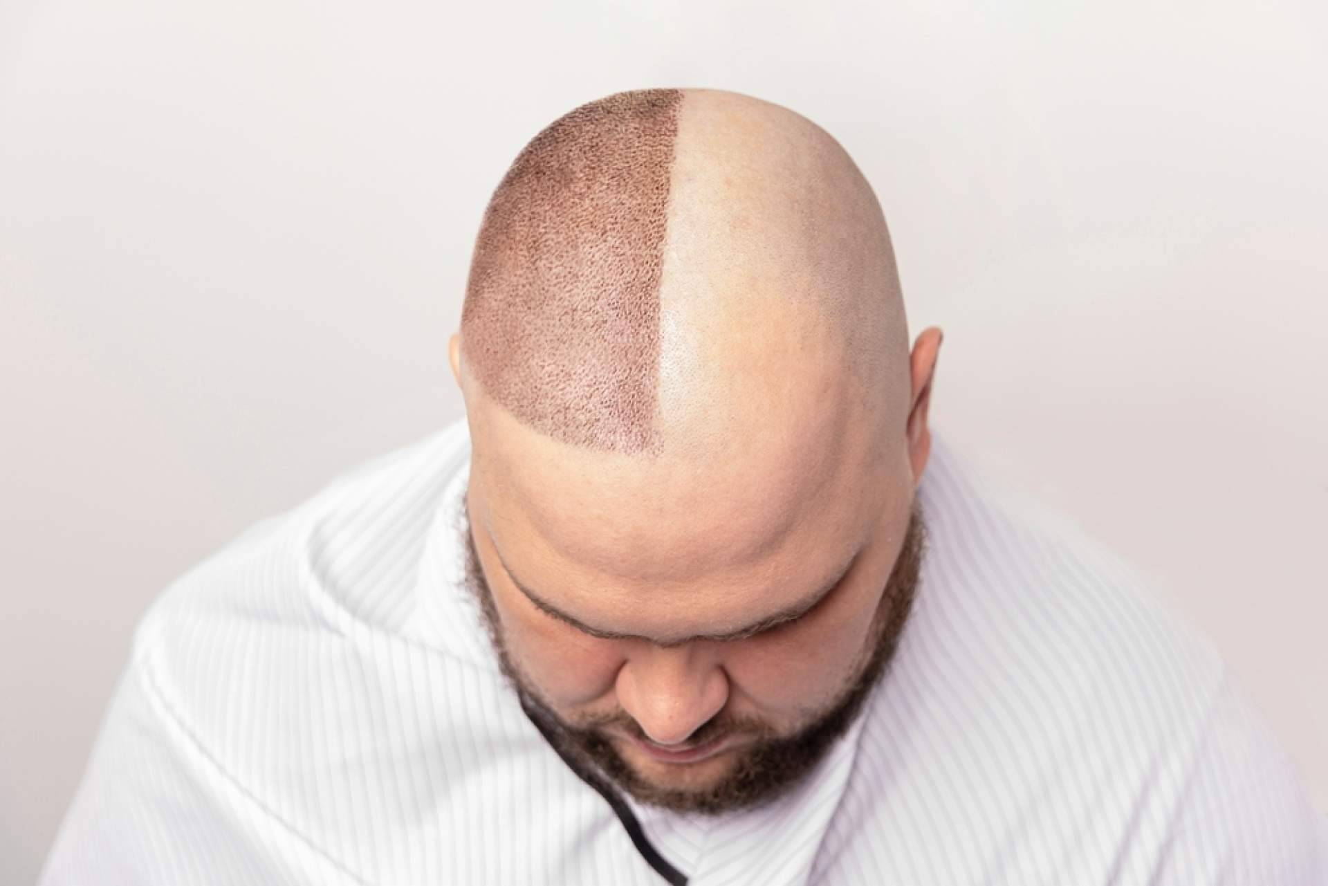 Trasplante capilar con efecto natural en 6 meses; la fórmula exclusiva del Dr. Aníbal Mora marca la diferencia