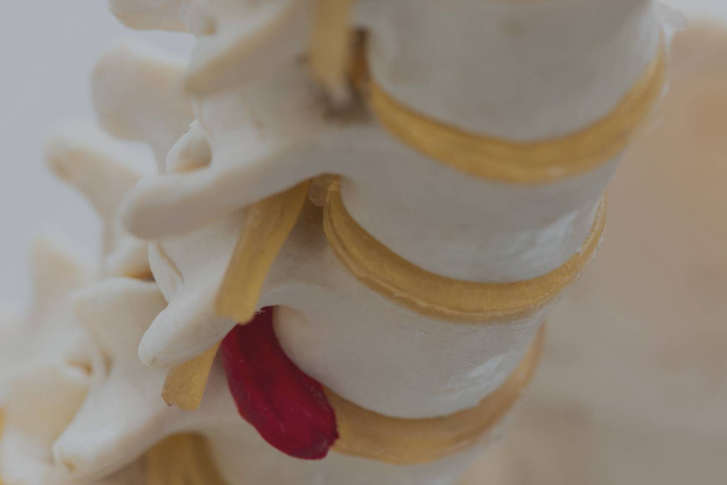 Las hernias discales se pueden trabajar sin necesidad de pasar por el quirófano gracias a la fisioterapia